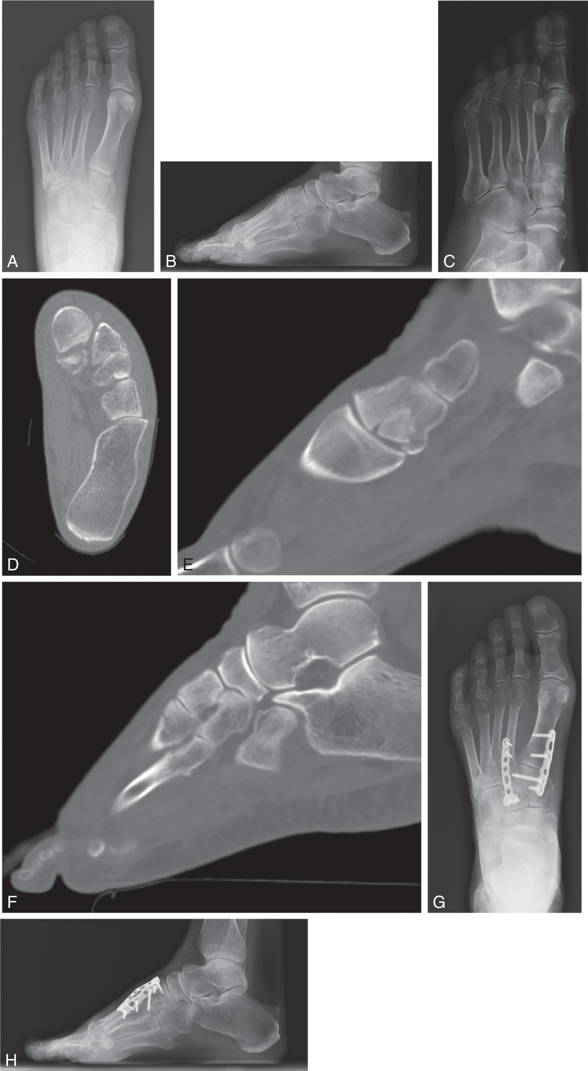 Fig. 47-14, (A to C) Three radiographic views and (D to F) CT scan reveal multiple metatarsal fractures and cuneiform articular impaction fractures. ( G and H ) Decompression of the articular surface and bridge plating is performed to restore length and maintain stability for healing.