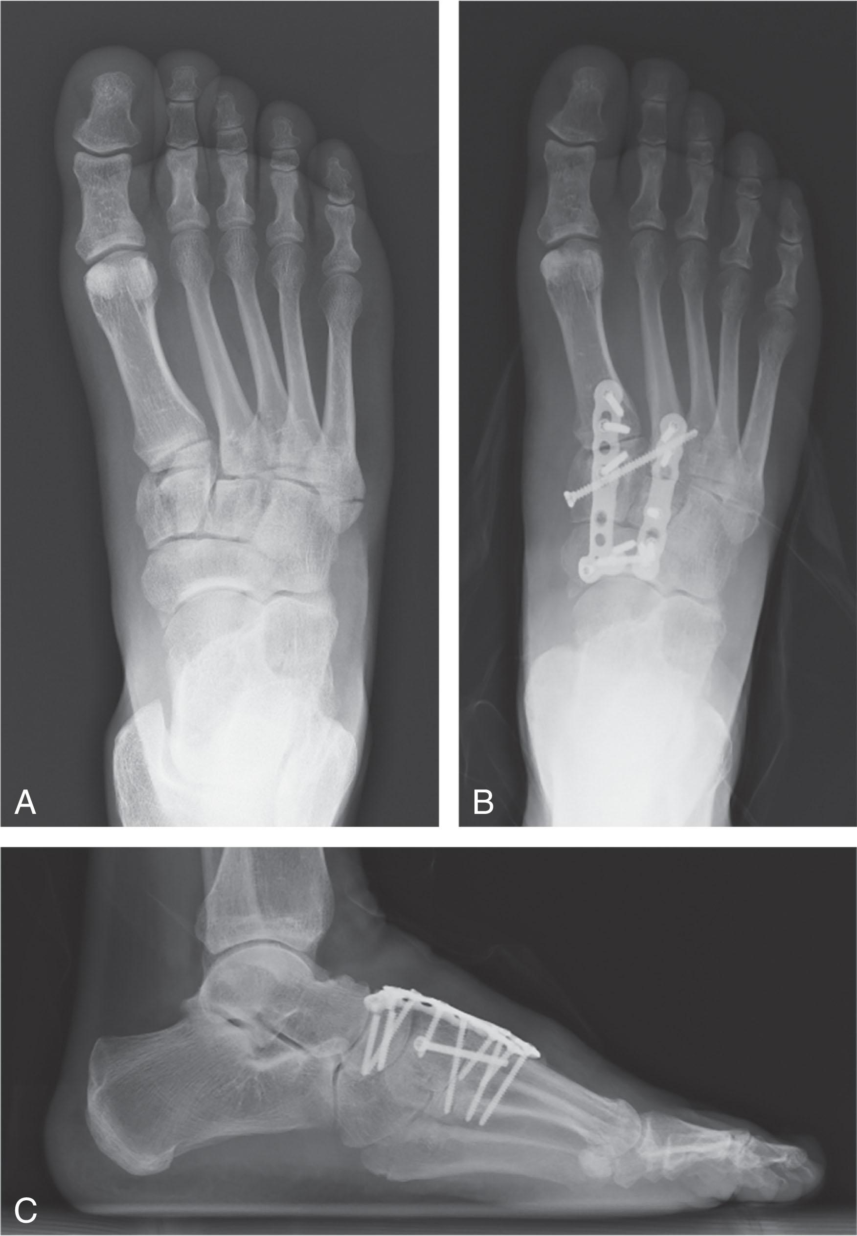 Fig. 47-15, A , Injury radiographs revealing a Lisfranc variant with a comminuted length unstable medial cuneiform fracture. B and C , This was treated with length restoration and bridge plating of the medial and intermediate column.