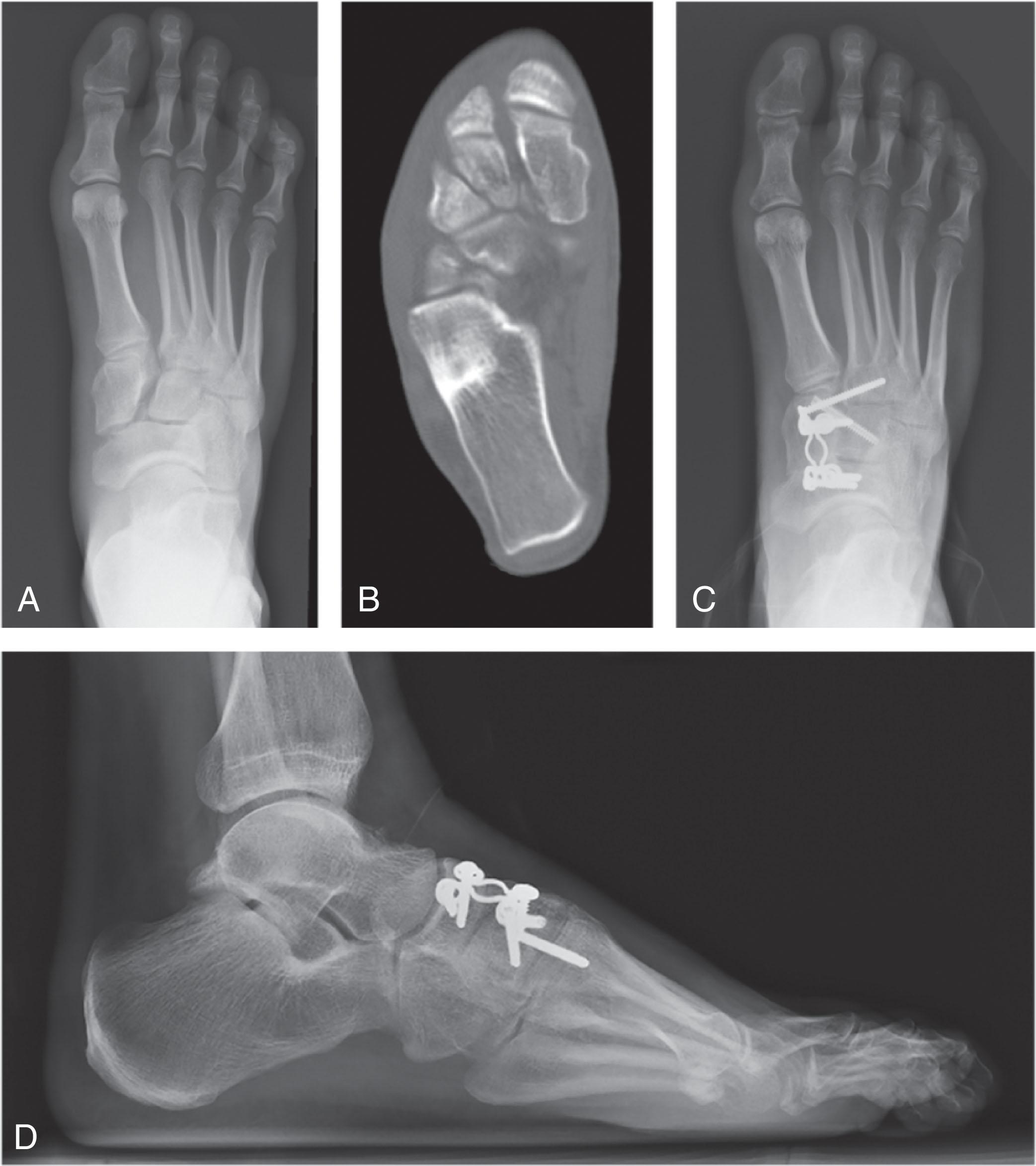 Fig. 47-16, An active 34-year-old attorney sustained a cross-fit injury with subsequent pain and instability of the medial column seen on x-ray (A) with cuneiform avulsion confirmed on CT scan (B) . After a thorough review of the treatment options, he elected to proceed with an arthrodesis ( C and D ) to ensure restoration of stability and decrease the possibility of future operations.