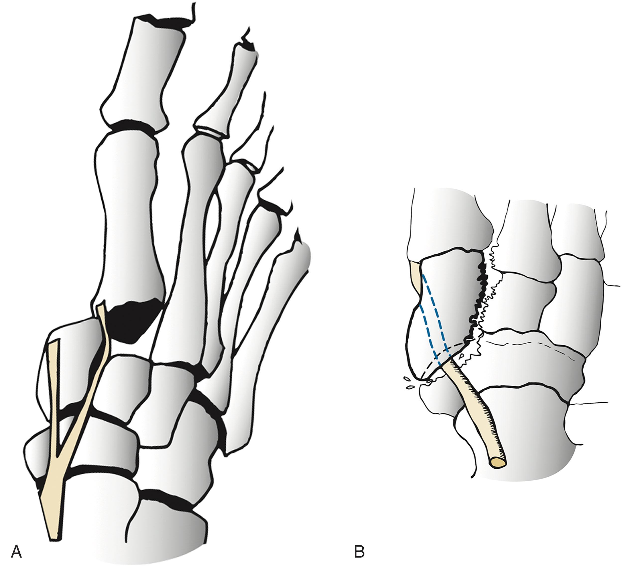 Fig. 47-17, Patterns of tibialis anterior tendon (TA) interposition. A , Simultaneous disruption of the first tarsometatarsal and intercuneiform joints allows interposition of the lateral slip of the TA between the medial and middle cuneiforms. B , Interposition of the TA between the dislocated medial cuneiform and navicular. ( A , From Lowe J, Yosipovitch Z: Tarsometatarsal dislocation: a mechanism blocking manipulative reduction. Case report, J Bone Joint Surg Am 58:1029–1030, 1976. B ,