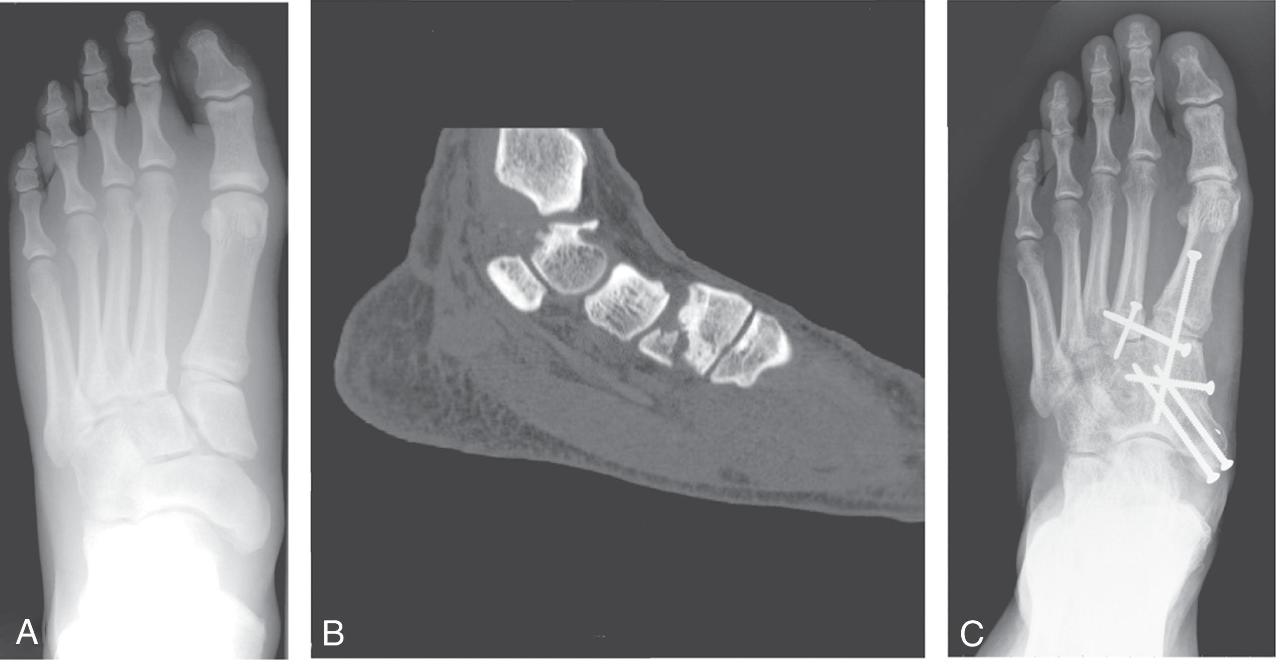 Fig. 47-18, A , Anteroposterior radiograph reveals dislocation of the medial cuneiform, with disruption of the naviculocuneiform, intercuneiform, and Lisfranc joints. B , Computed tomography scan demonstrates articular fracture of the medial cuneiform. C , Because of severe joint damage, primary fusion of the naviculocuneiform joint was performed along with standard open reduction and internal fixation of the first and second tarsometatarsal joints and Lisfranc joint.