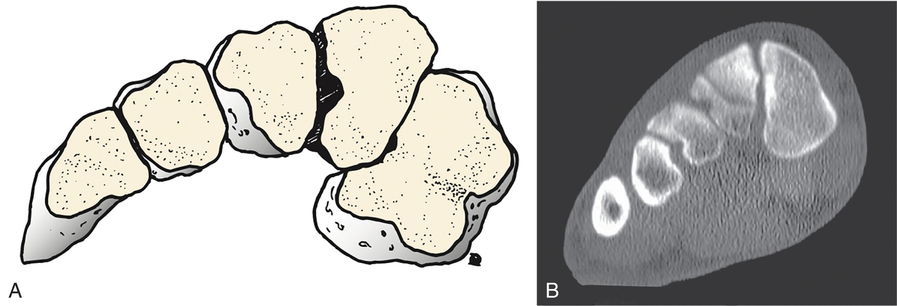 Fig. 47-19, Schematic representation (A) and computed tomography scan (B) demonstrate the Roman arch configuration of the tarsometatarsal joint complex.