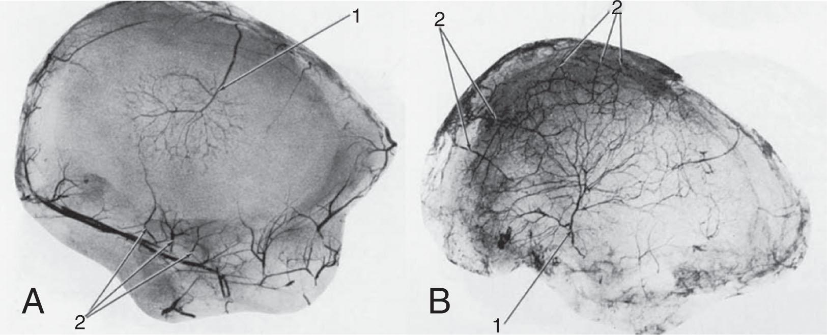 Fig. 47-2, Blood supply to navicular. A , In this 4-year-old girl, most of the blood supply to the navicular comes from a single artery (1) , with a few penetrating radiate vessels (2) . B , Similar findings in a 13-year-old boy.