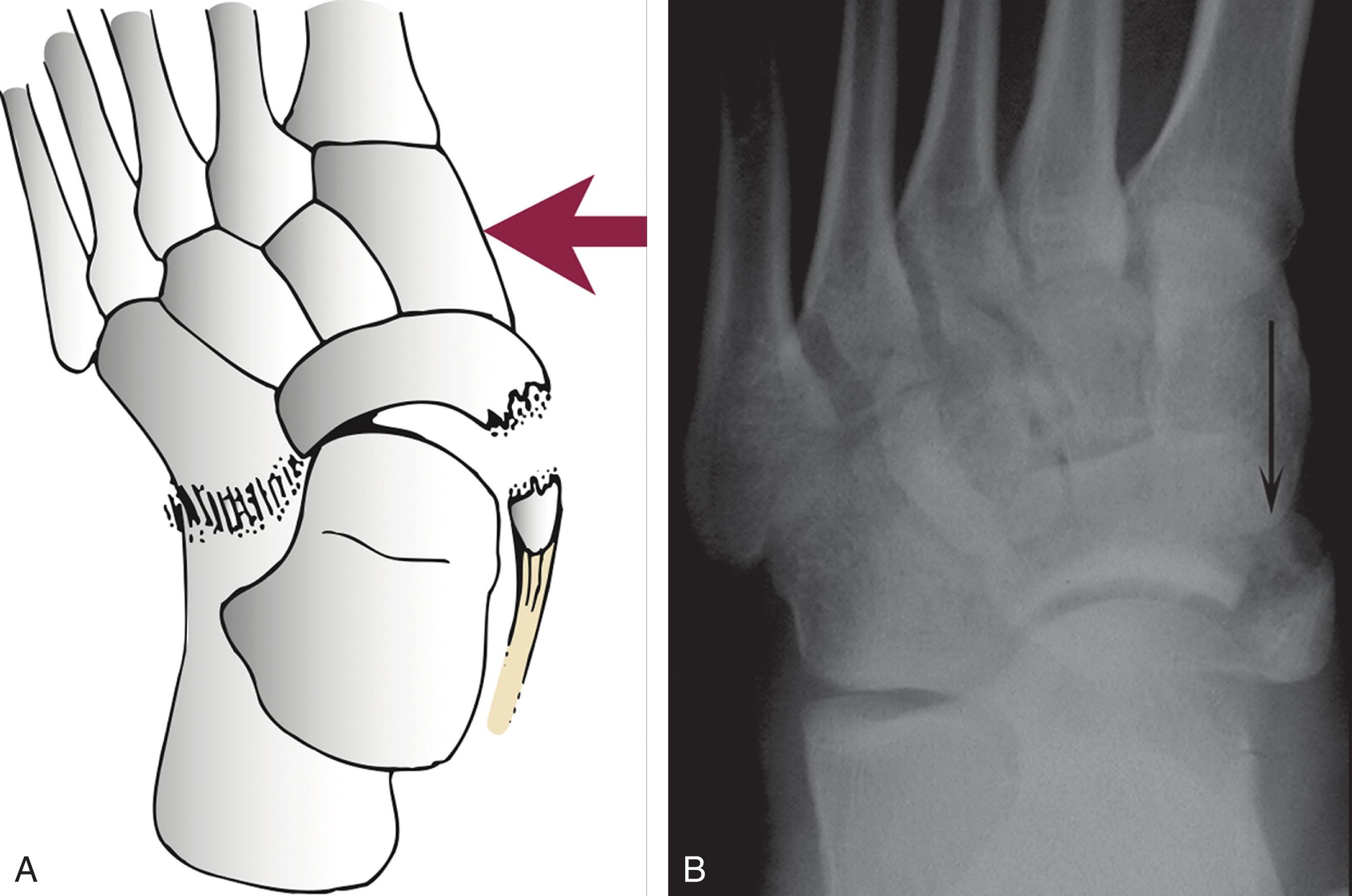 Fig. 47-3, Navicular tuberosity avulsion fracture. A , Arrow in schematic drawing represents laterally directed force producing midtarsal injury, resulting in typical navicular tuberosity avulsion and lateral midtarsal subluxation. B , Tuberosity avulsion fracture (arrow) .