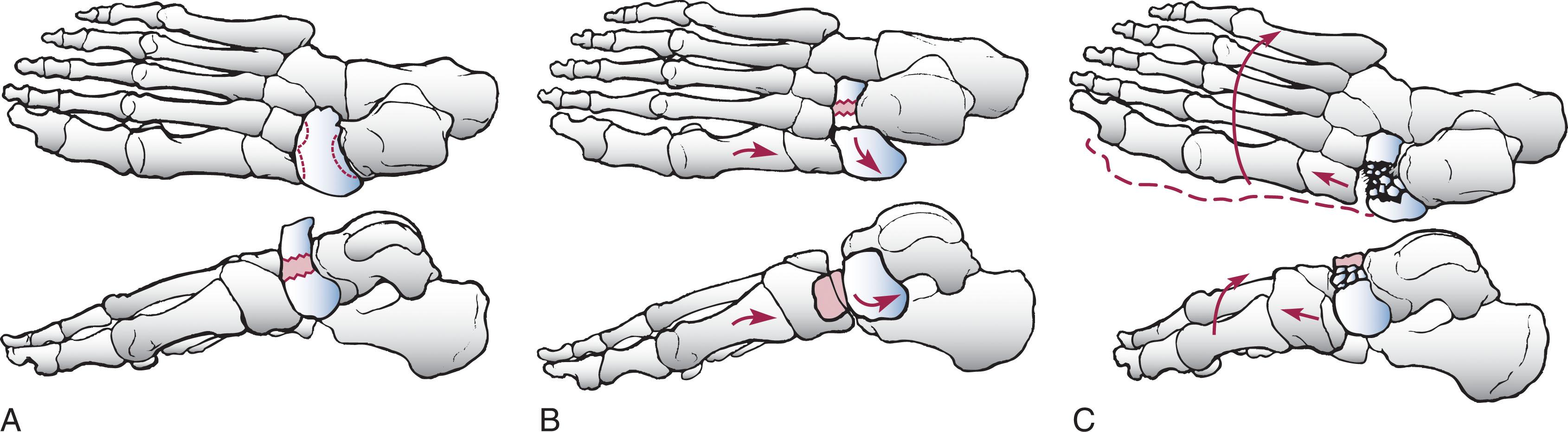 Fig. 47-4, Classification of navicular body fractures according to Sangeorzan et al. 16 A , Type 1. B , Type 2. C , Type 3.