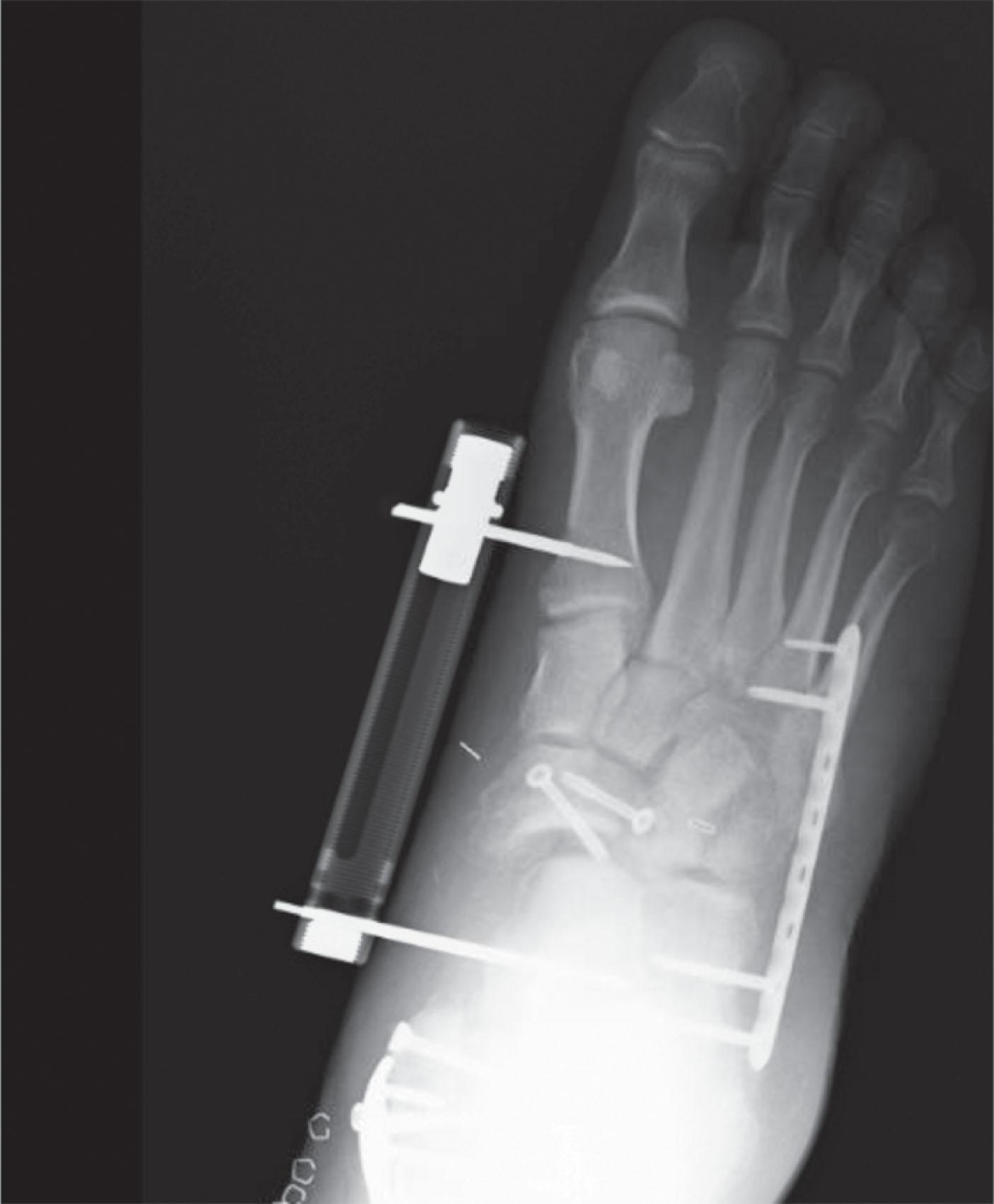 Fig. 47-5, This patient sustained a navicular body fracture as well as a lateral-sided crush injury. The injuries were treated with a lateral column bridge plate to maintain length on the lateral side. The navicular body was treated with lag screw fixation and a medical column external fixator, to maintain length on the medial side and reduce the load on the navicular.