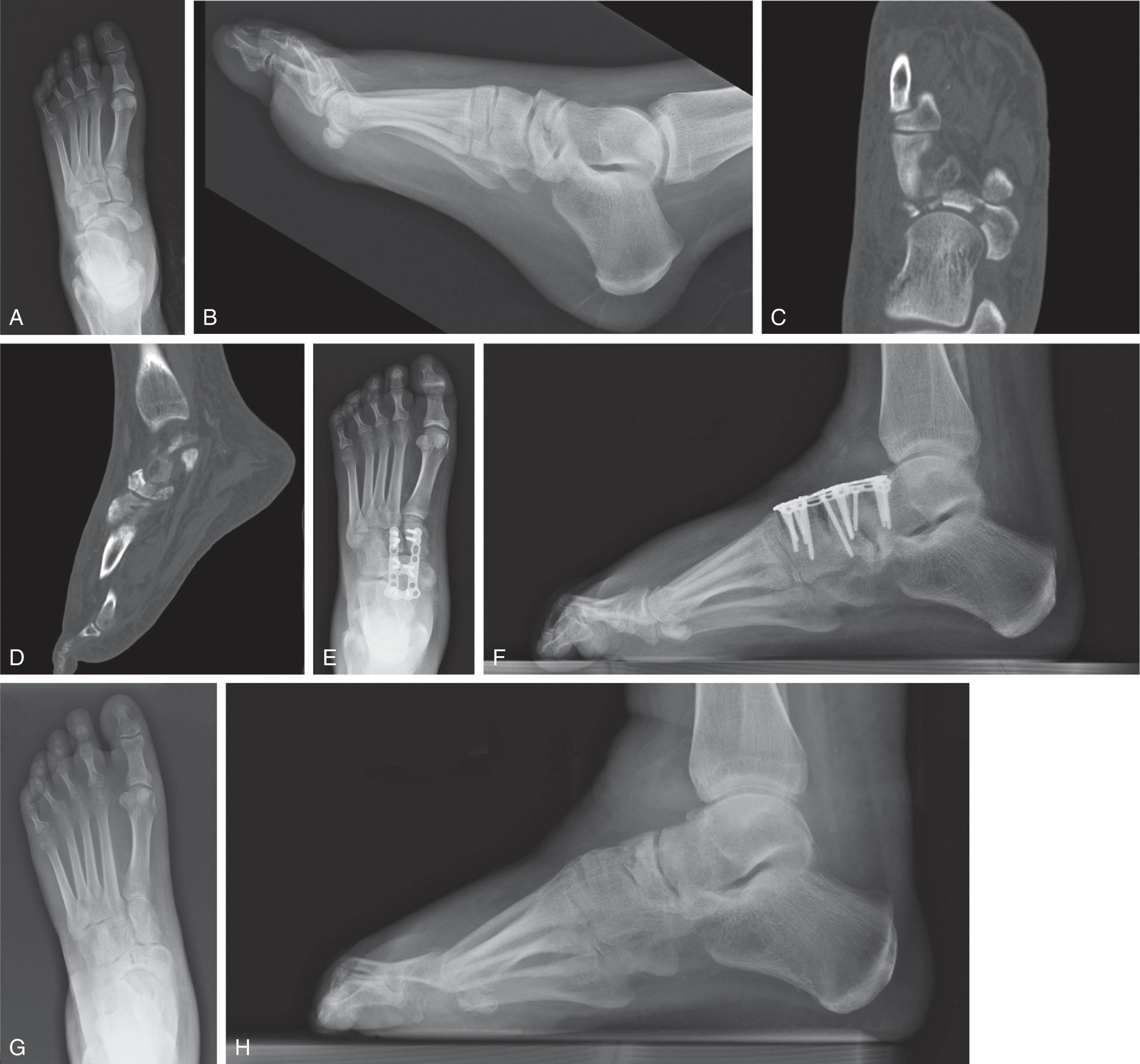Fig. 47-6, AP (A) and lateral (B) injury radiographs with CT scan ( C and D ) revealing a comminuted navicular fracture with articular impaction in an uncontrolled diabetic patient. AP (E) and lateral (F) postsurgical radiographs of a bridge-plating construct to span the impacted medial column that was subsequently removed 6 months later ( G and H ). AP , Anteroposterior.