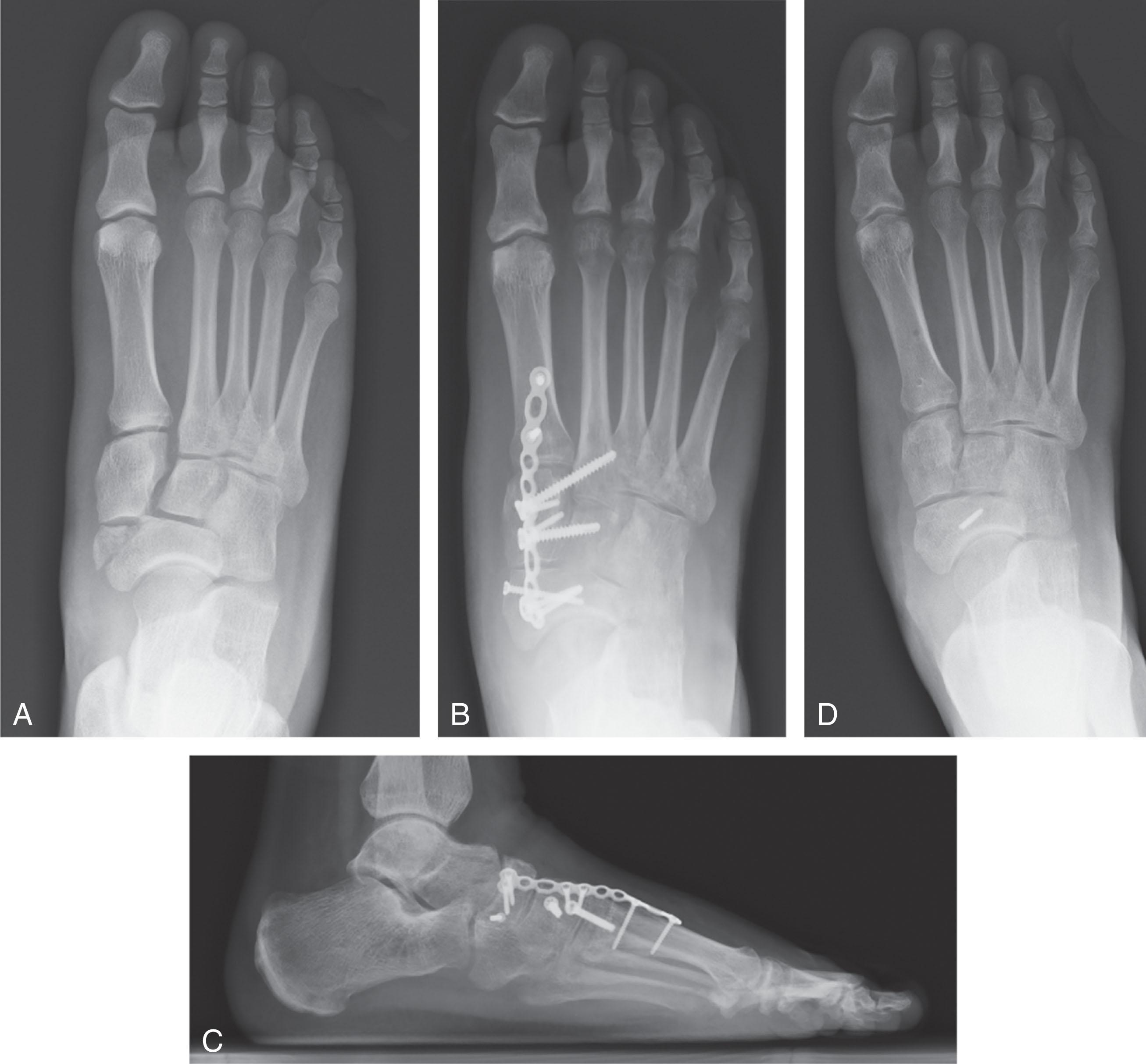 Fig. 47-7, Complete medial column instability propagating proximally with shortening and diastasis through a sheer fracture of the tarsal navicular (A) . Stability was restored with bridge plate fixation of the medial column and restoration of the medial/intermediate column relationship with screw fixation ( B and C ). Hardware removal 9 months later was performed and 1-year postinjury radiographs reveal a broken navicular screw but generalized maintenance of anatomic alignment (D) .