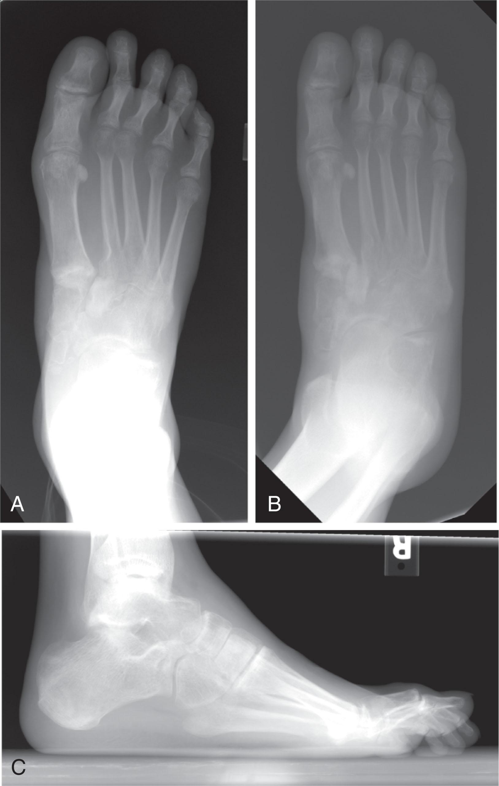 Fig. 47-8, Anteroposterior (A) , oblique (B) , and lateral (C) radiographs of chronic, untreated, longitudinal midtarsal injury with navicular fracture and shortening of the medial column. Patient presented with cock-up hallux deformity, pain beneath first metatarsal head, and lesser metatarsalgia.