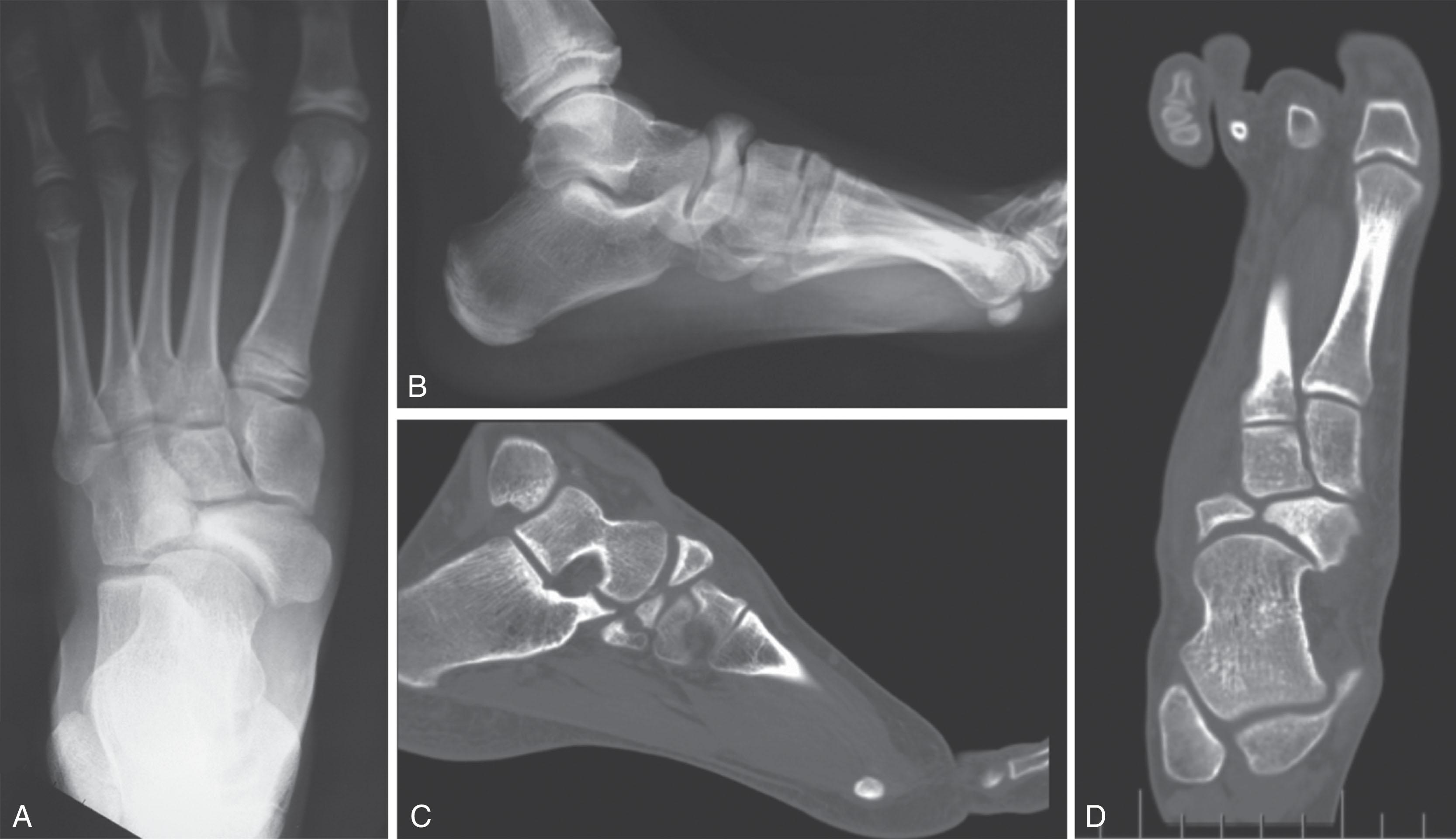 Fig. 47-9, A and B , Anteroposterior and lateral radiographs of a patient with a bipartite navicular. Note the comma-shaped appearance and the dense sclerosis, indicating the chronic nature of the radiographic findings. C and D , A single sagittal computed tomography scan slice of the same patient, followed by a single representative axial slice. Again note the well-corticated edges of the bipartite navicular, in contradistinction to Fig. 47-10 , which shows an acute stress fracture.