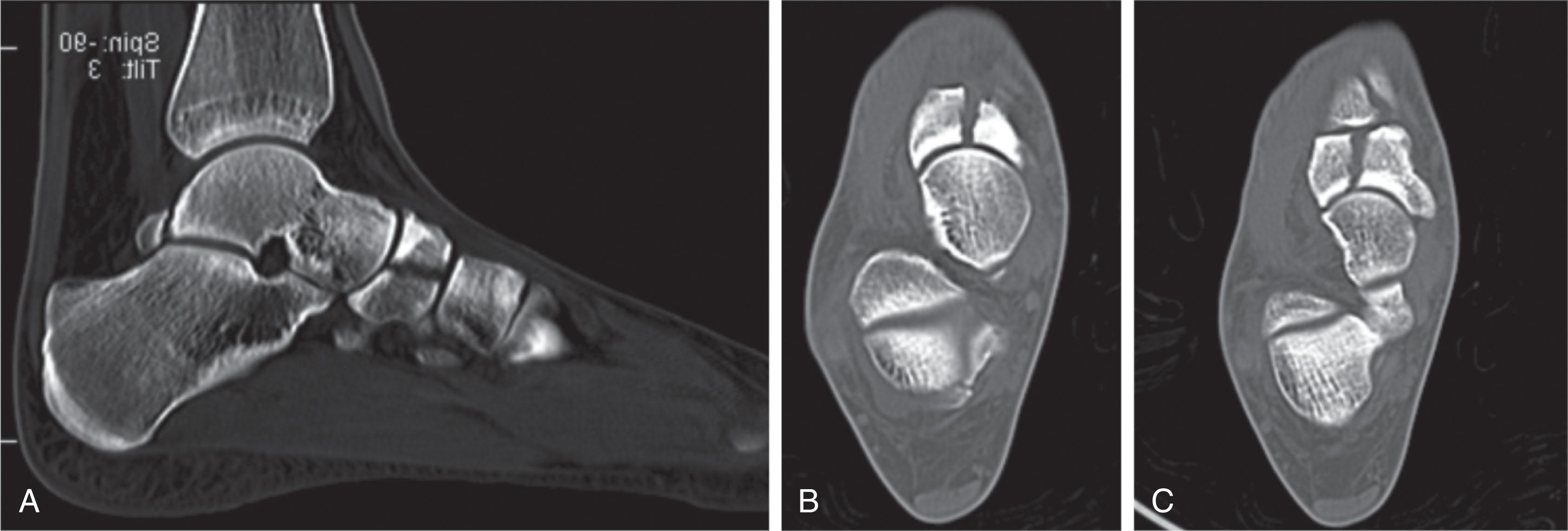 Fig. 47-10, A , A representative sagittal computed tomography (CT) slice from a patient with a navicular stress fracture. B and C , The next two images are sequential axial CT scan slices from the same patient. Note the classic orientation of the fracture line from distal to proximal.