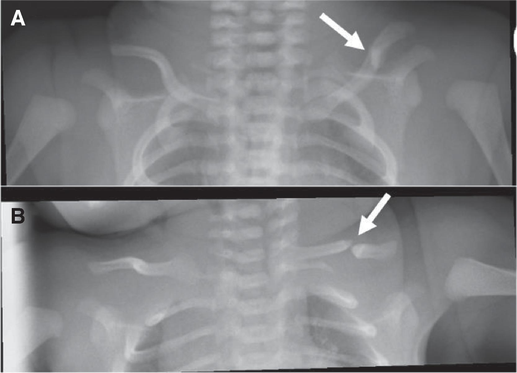 Fig. 74.1, Supine AP Radiographs of a Newborn Female With a Midshaft Fracture of the Right Clavicle Detected Shortly After Birth (White Arrows) .
