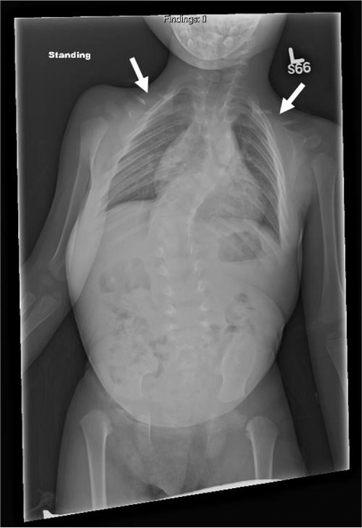 Fig. 74.2, Full Spine Standing AP (Anterior-Posterior) Radiograph of a Male Patient With Cleidocranial Dysplasia Affecting the Bilateral Clavicles (White Arrows) .