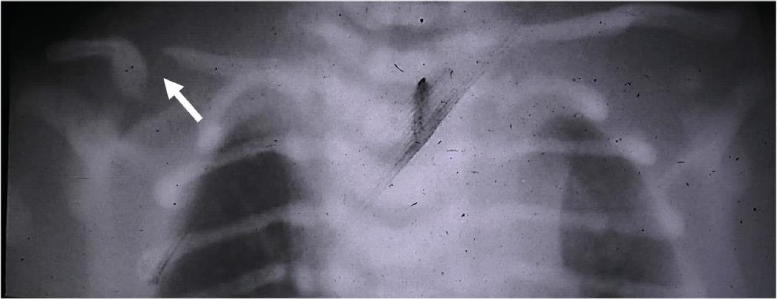 Fig. 74.3, Upper Thoracic AP (Anterior-Posterior) Radiograph of a Female Patient With Congenital Pseudarthrosis of the Right Clavicle (White Arrow) .