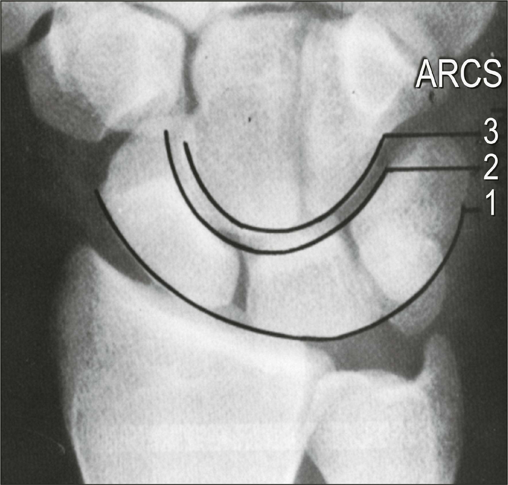 Figure 8.4, The Gilula arcs are used to detect alterations in carpal alignment and stability. The lines are defined by (1) the proximal and (2) the distal articular surface of the proximal row, as well as (3) the proximal articular surface of the distal row.