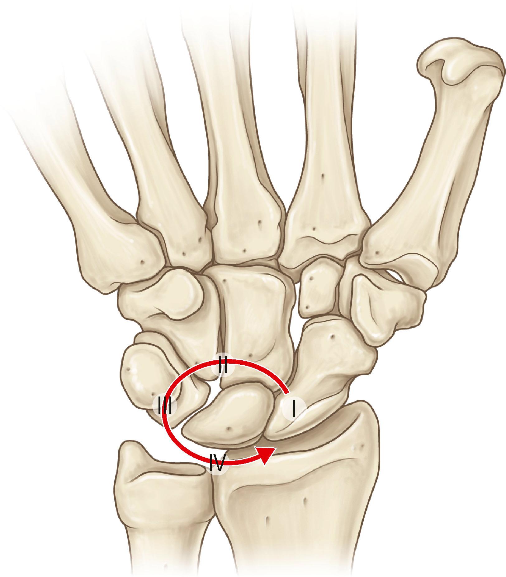 Figure 8.6, Mayfield stages of perilunate instability: (I) scapholunate ligament rupture; (II) volar capsule tear at the spae of Poirer; (III) lunotriquetral ligament rupture; (IV) lunate dislocation.