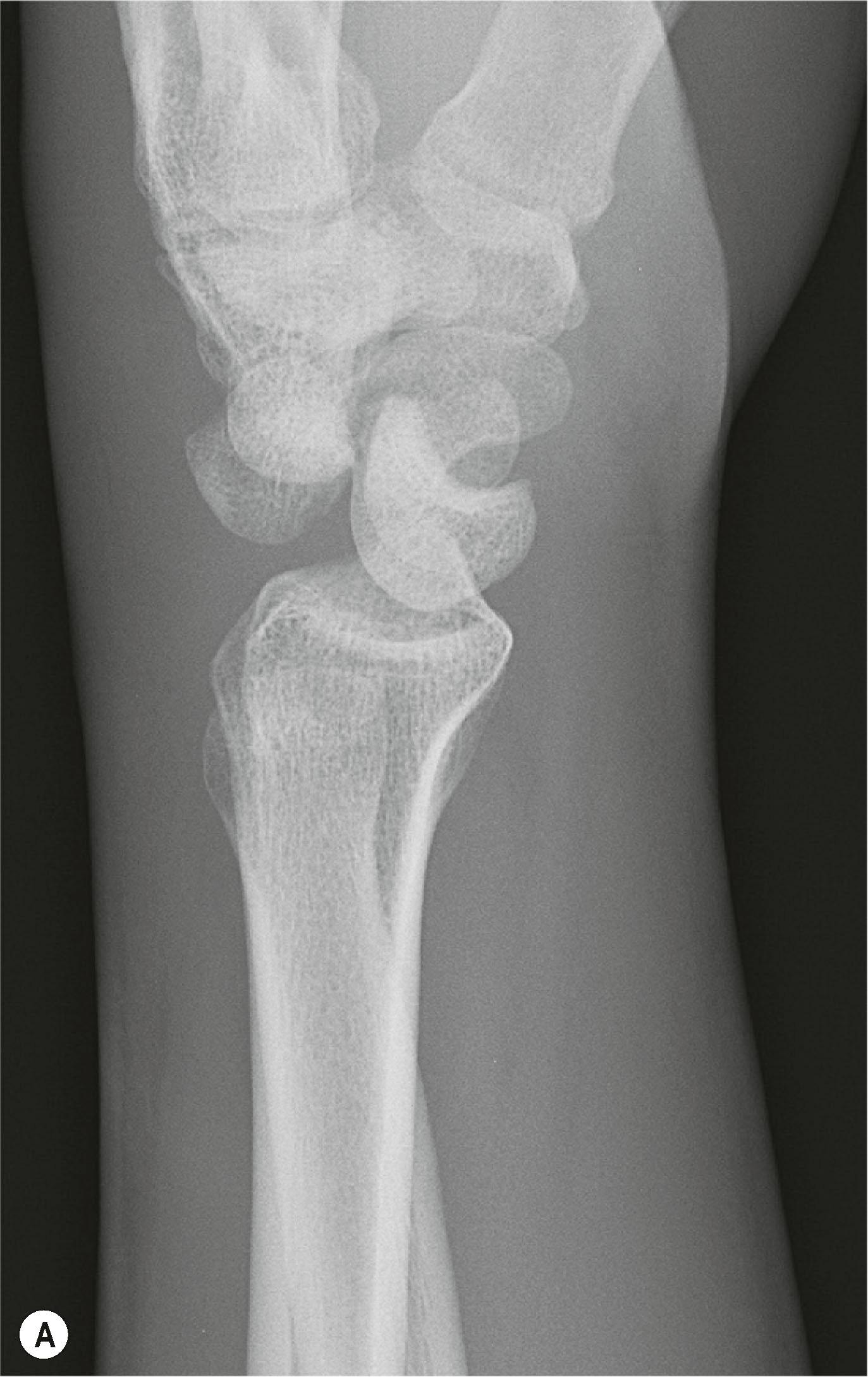 Figure 8.7, Lateral radiograph examples of (A) perilunate dislocation and (B) lunate dislocation injury patterns.