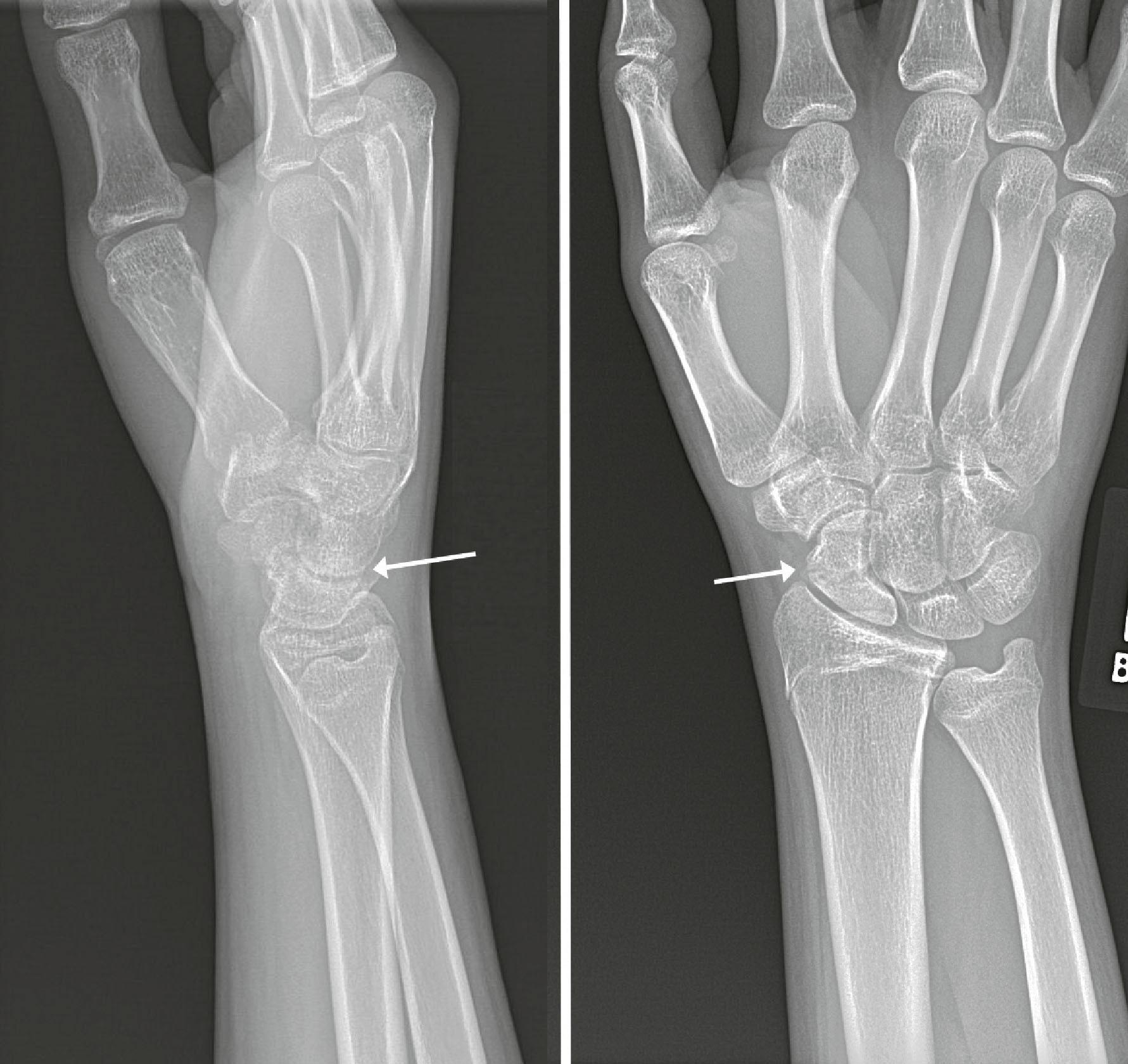 Figure 8.9, Fracture at the waist of the scaphoid, resulting in a humpback deformity.