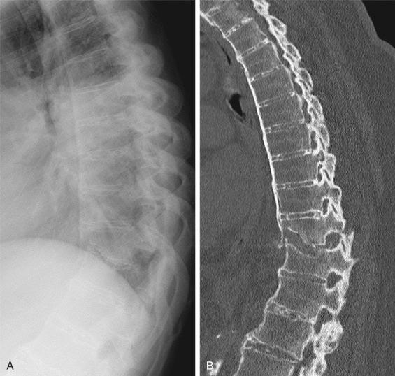 Fig. 34.1, Lateral conventional radiograph (A) and sagittal reconstruction of computed tomography (CT) scan (B) of the thoracic spine of a 72-year-old male with an ankylosed spine showing radiographic abnormalities matching both ankylosing spondylitis (AS) and diffuse idiopathic skeletal hyperostosis (DISH). The patient was admitted to the hospital 3 weeks after a fall from standing height without neurologic deficit. Imaging exposed an unstable B3 fracture of T10.