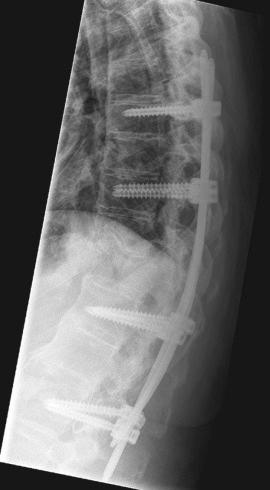 Fig. 34.2, Lateral conventional radiograph of the same patient as in Fig. 34.1 showing the thoracic spine 6 weeks after percutaneous fixation with long segment pedicle screw instrumentation from T7 to L2.