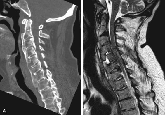 Fig. 34.3, Sagittal reconstruction of computed tomography (CT) and magnetic resonance imaging (MRI) scan of the cervical spine of the same male patient as Figs. 34.1 and 34.2 at the age of 74 years. The patient was admitted to a hospital abroad after a fall from a standing position and was discharged after a CT was obtained and no fractures had been observed. Neurologic deficit (American Spinal Injury Association [ASIA] classification D) started to develop a week after the initial trauma, and 12 days later, a new CT was acquired (A) showing a fracture of C5. The diagnosis of an unstable type B3 fracture of C5 was confirmed by MRI scan (B; T2 weighted), and HALO stabilization was applied in anticipation of surgery.