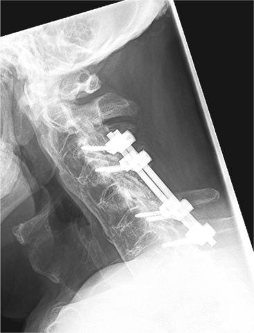 Fig. 34.4, Lateral conventional radiograph of the same patient as in Figs. 34.1 to 34.3 showing the cervical spine 7 weeks after the initial trauma and 5 weeks after open stabilization from C3 to C7. The neurologic deficit improved after the surgery (American Spinal Injury Association [ASIA] classification E).
