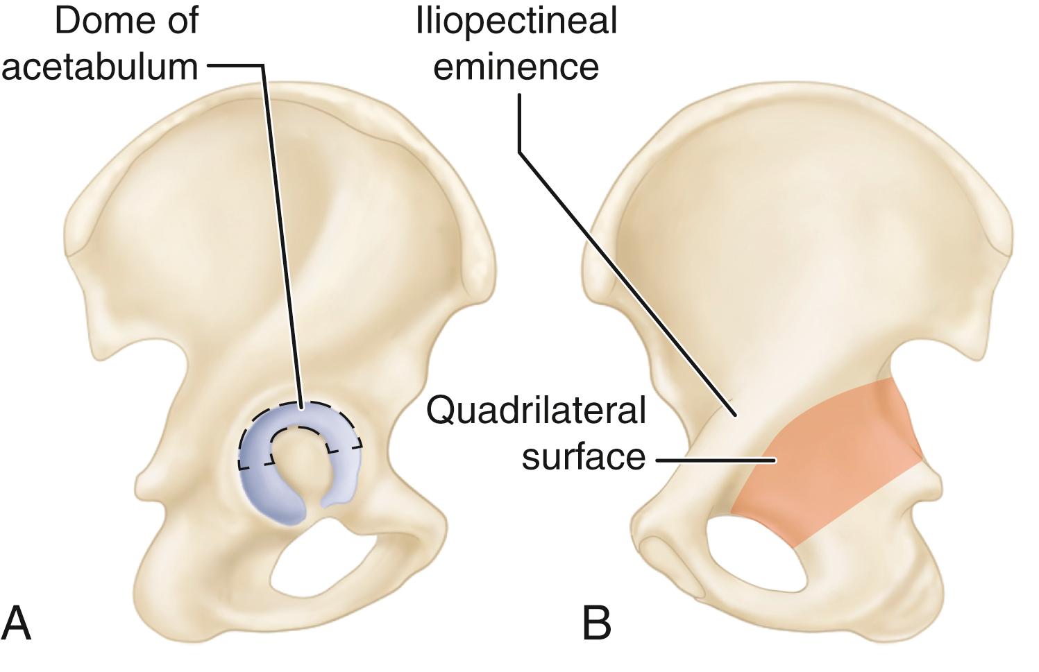 FIGURE 56.5, A, Iliopectineal eminence overlies dome of acetabulum. B, Quadrilateral surface lies adjacent to medial wall of acetabulum.