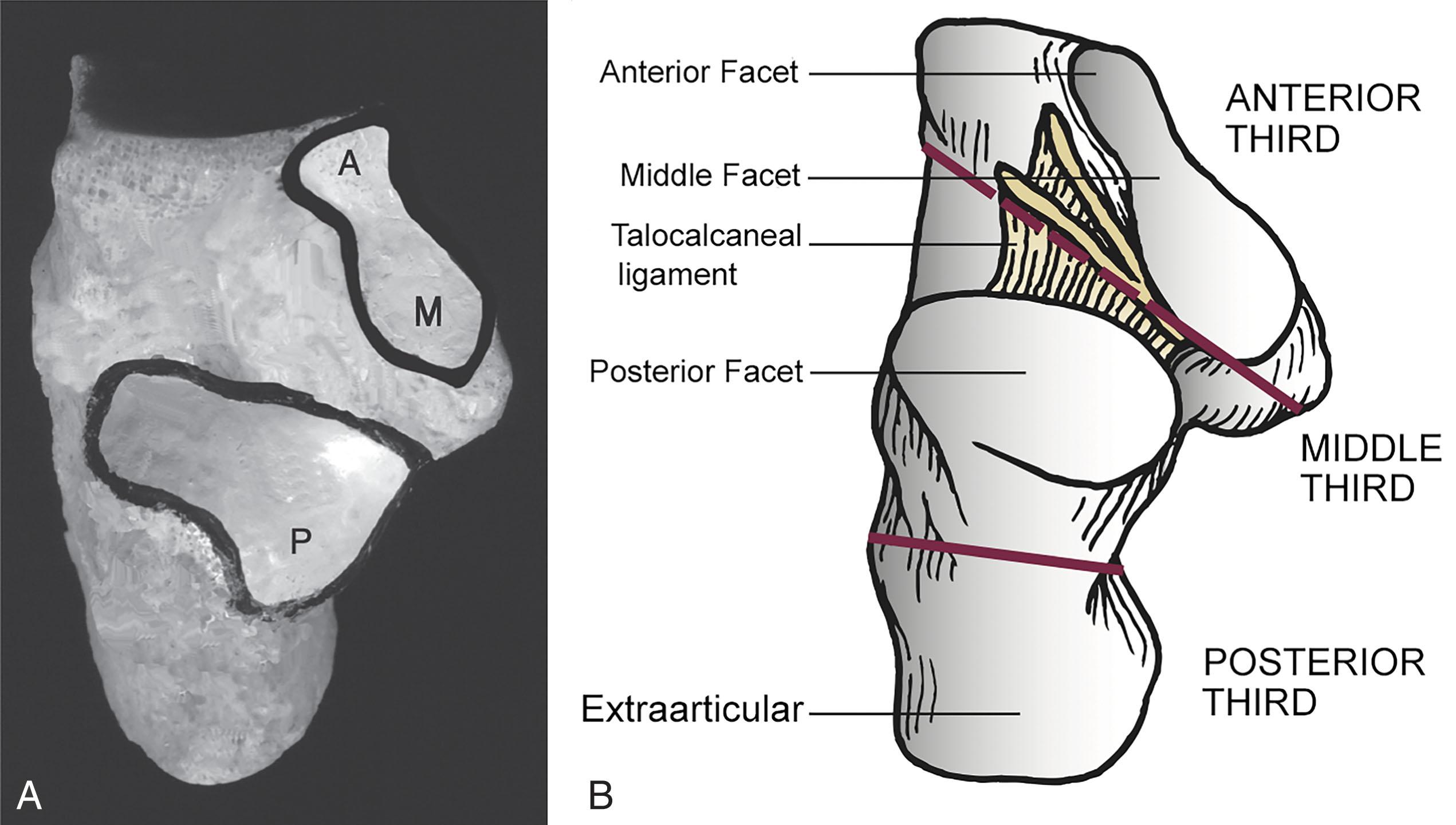 Fig. 45-1, Photographic ( A ) and schematic ( B ) views of superior surface of the calcaneus. The large posterior facet (P) straddles the medial and lateral portions of the bone. Medially, anterior (A) and middle (M) facets sit along the sustentaculum tali.