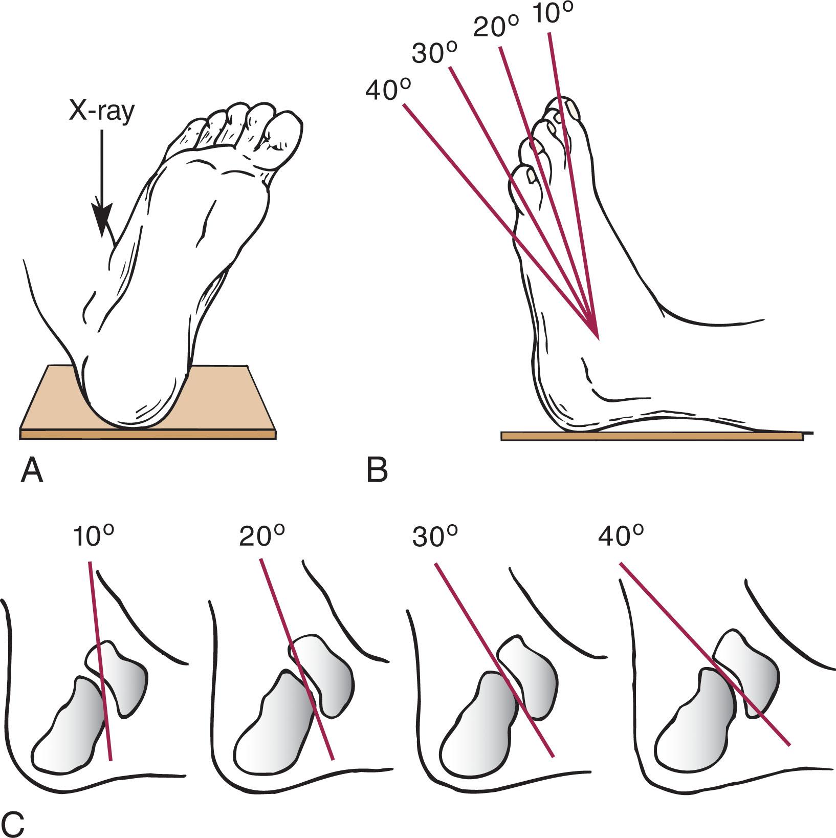 Fig. 45-11, Brodén's view. A , Positioning of foot. B and C , Views of 10 to 40 degrees are obtained by moving the x-ray beam tangential to the facet.