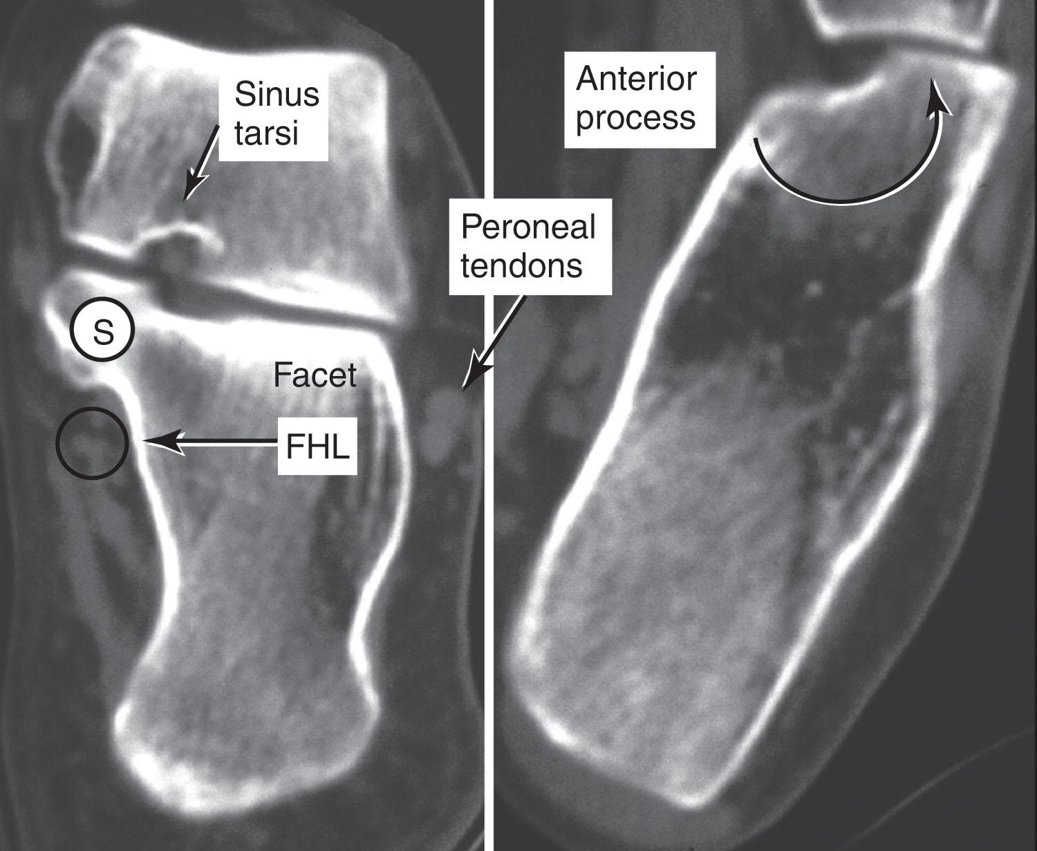 Fig. 45-12, Coronal (left) and transverse (right) computed tomography scans of a noninjured calcaneus. FHL , Flexor hallucis longus tendon; S , sustentaculum tali.