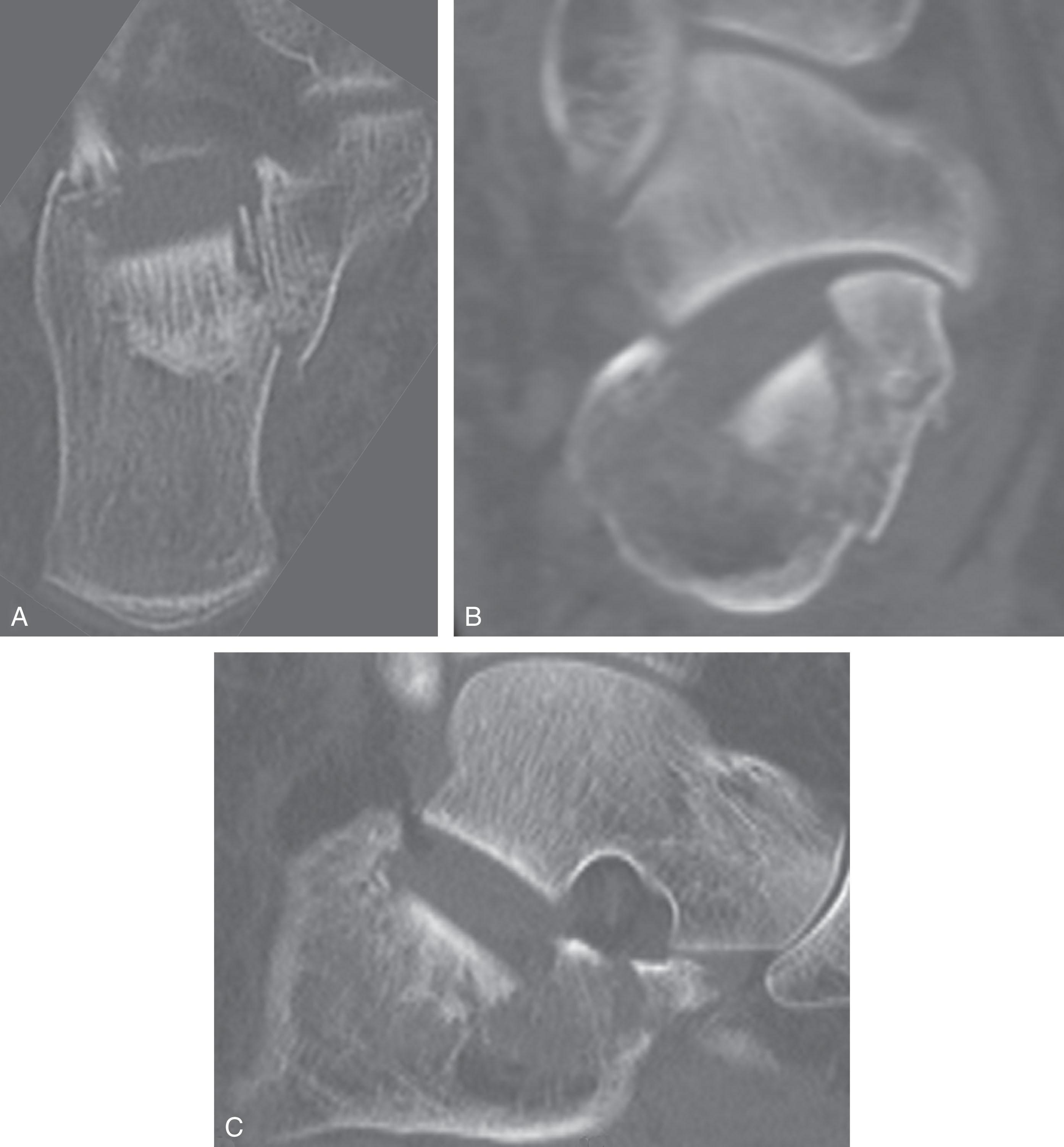 Fig. 45-13, Computed tomography of a displaced joint depression–type intraarticular fracture in a 78-year-old woman. A , Axial, B , coronal, and C , sagittal cuts demonstrating the displaced intraarticular fracture pattern.