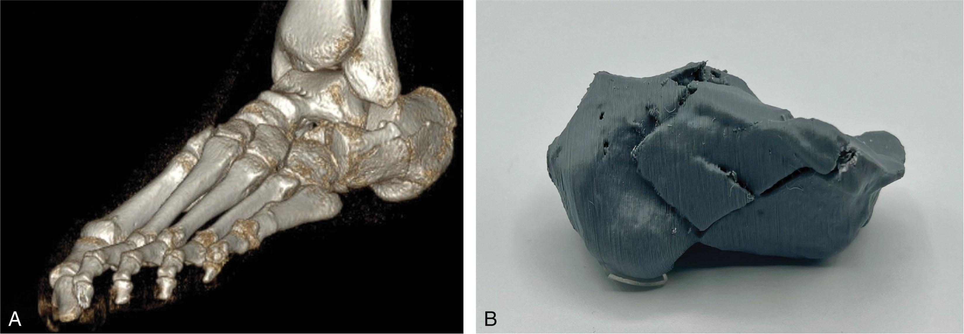 Fig. 45-14, Data from computed tomography scans can be used to create three-dimensional graphical representation (A) or additive printed models (B) of calcaneus fractures, which may help the surgeon visualize fracture patterns, particularly when using minimally invasive reduction and fixation techniques.
