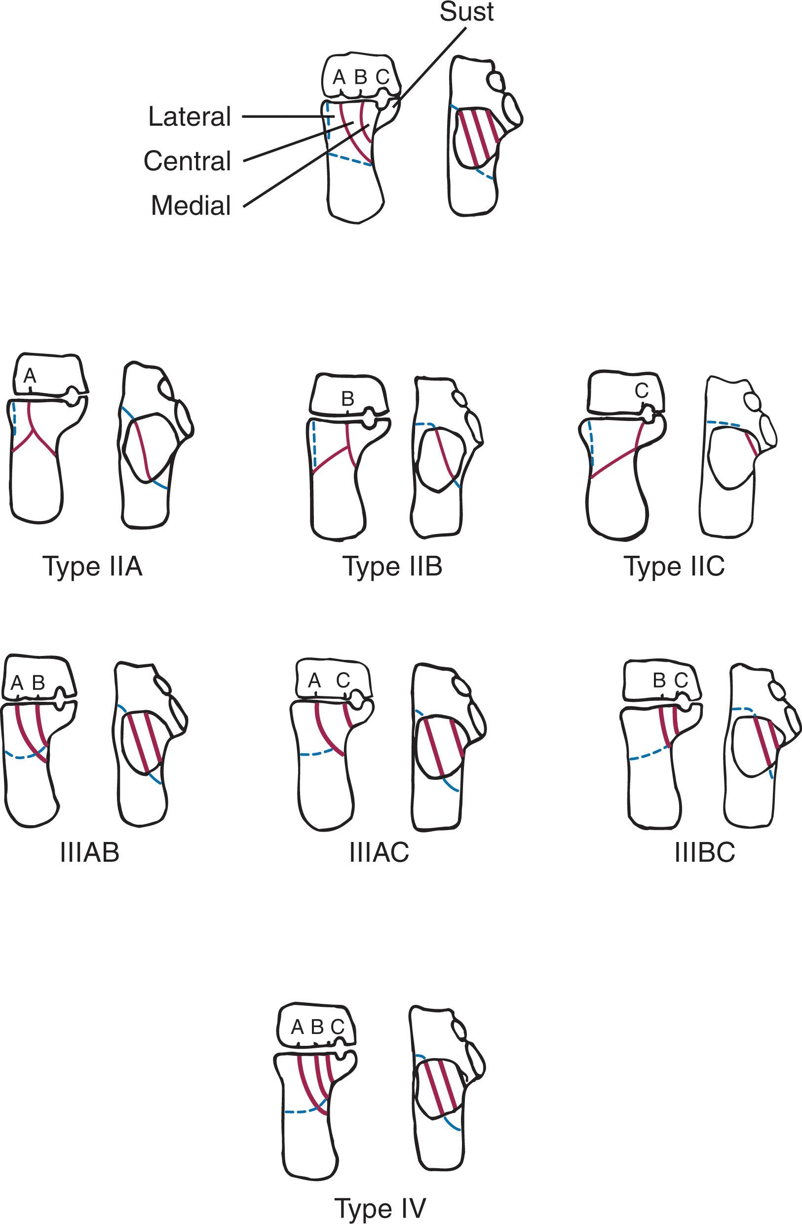 Fig. 45-15, Sanders computed tomography classification of calcaneal fractures. Sust , sustentaculum tali.