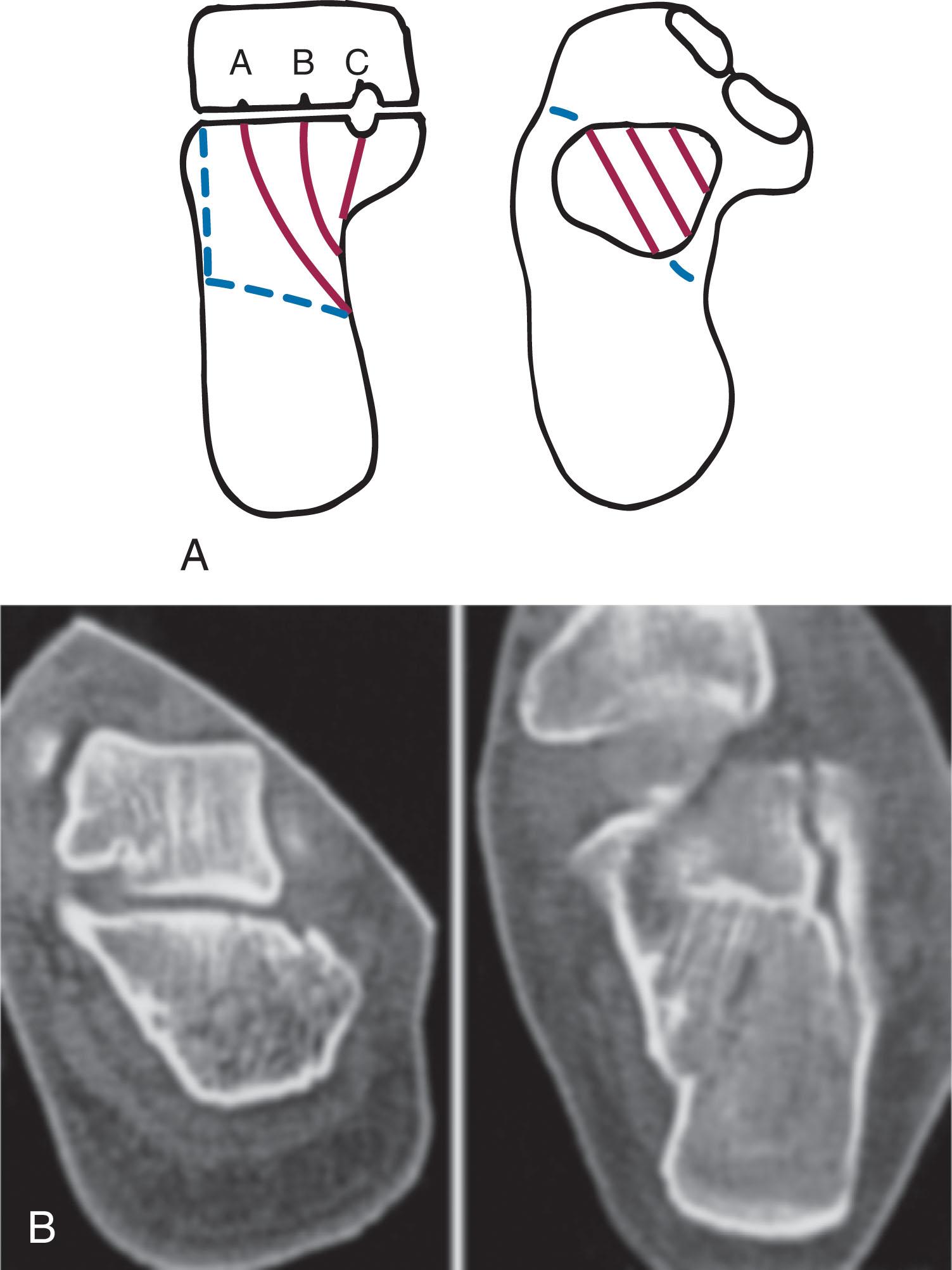 Fig. 45-16, A , Sanders type I nondisplaced intraarticular calcaneal fracture. B , Coronal and transverse computed tomography views show no articular displacement.