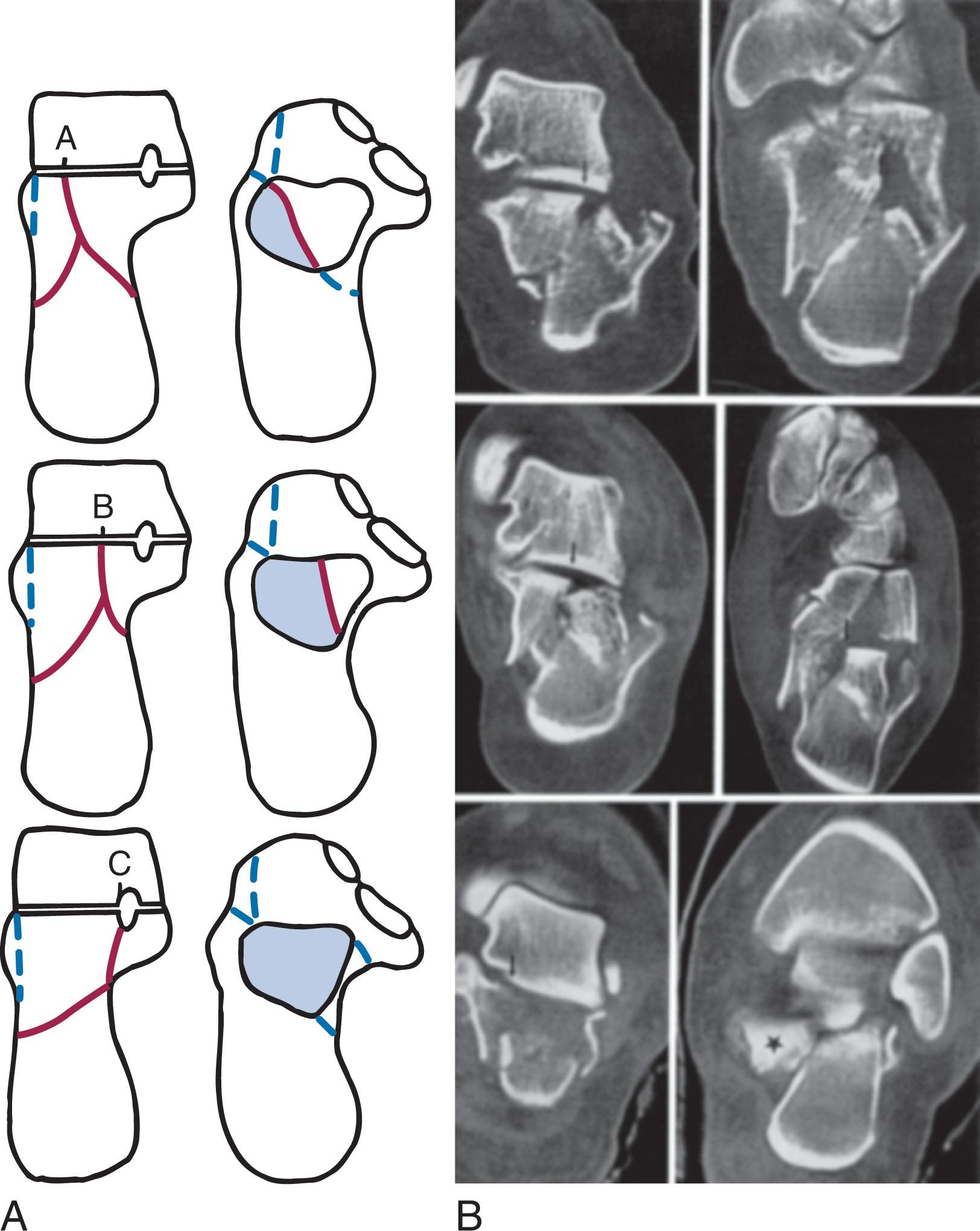 Fig. 45-17, Sanders types IIA, IIB, and IIC intraarticular calcaneal fractures. A , Coronal and horizontal plane diagrams. B , Corresponding computed tomography images.