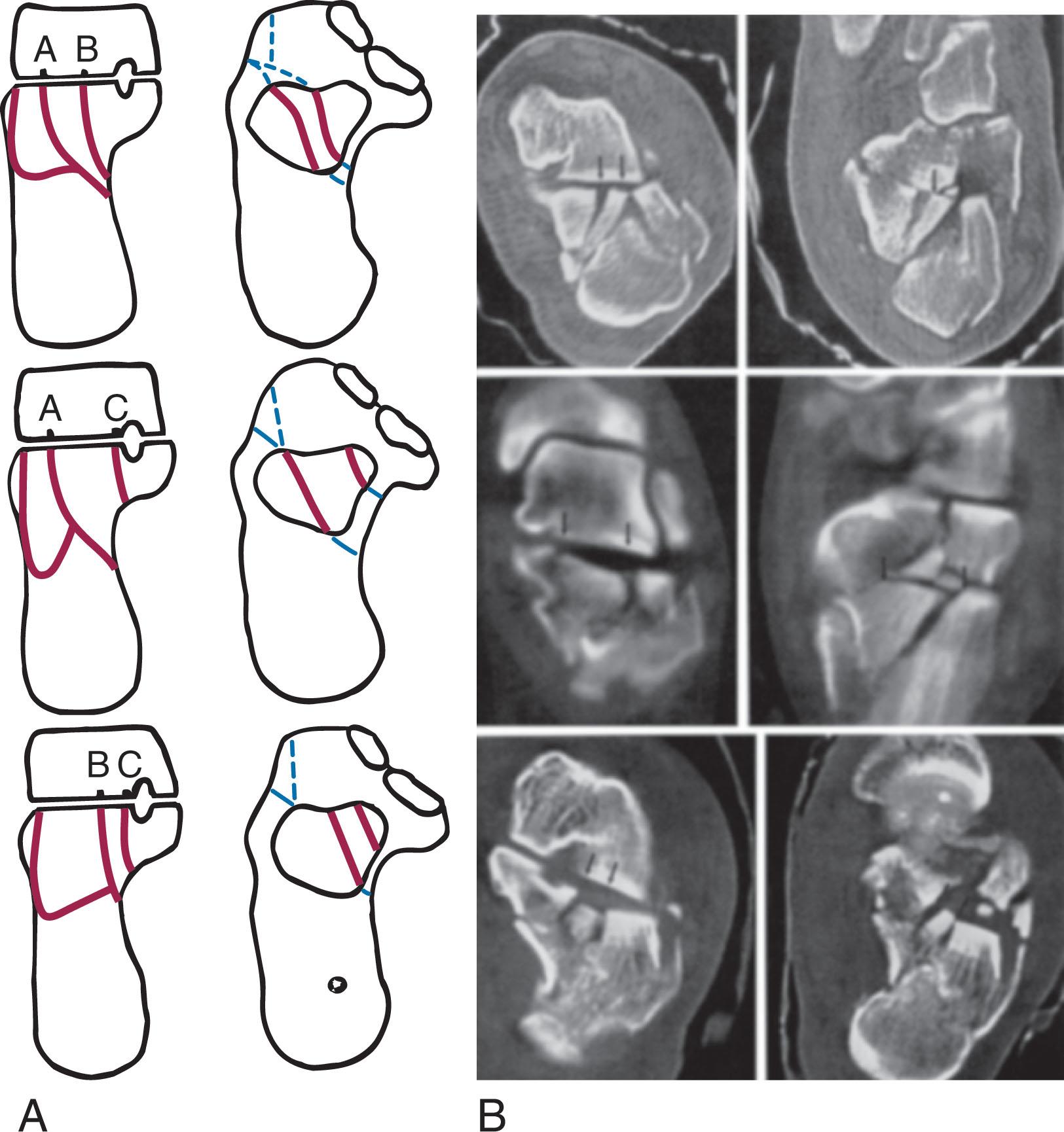 Fig. 45-18, Sanders types IIIA, IIIB, and IIIC intraarticular calcaneal fractures. A , Coronal and horizontal plane diagrams. B , Corresponding computed tomography images.