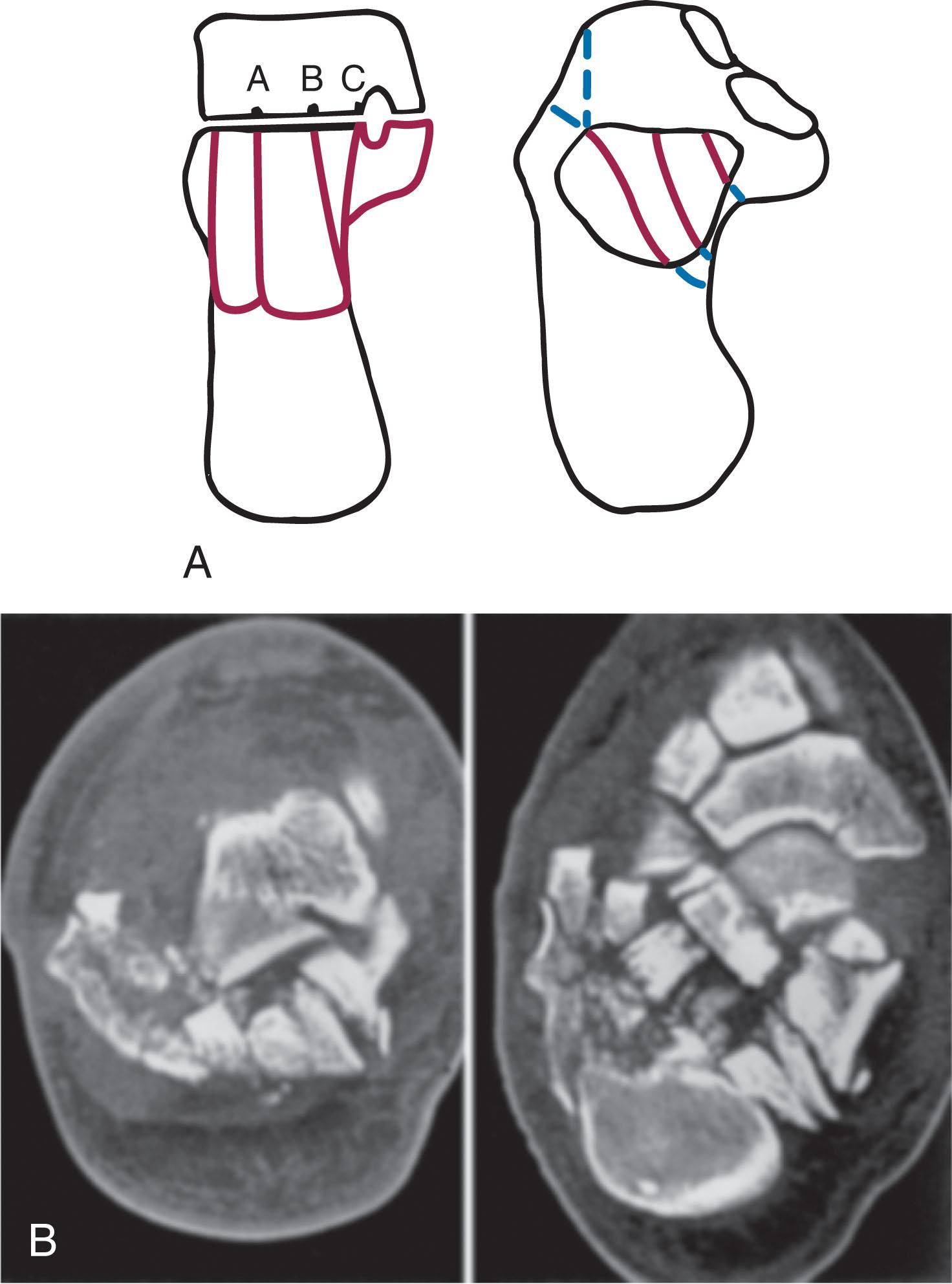 Fig. 45-19, Sanders type IV intraarticular calcaneal fracture. More than four articular fracture fragments may be present. A , Coronal and horizontal plane diagrams. B , Corresponding computed tomography images.