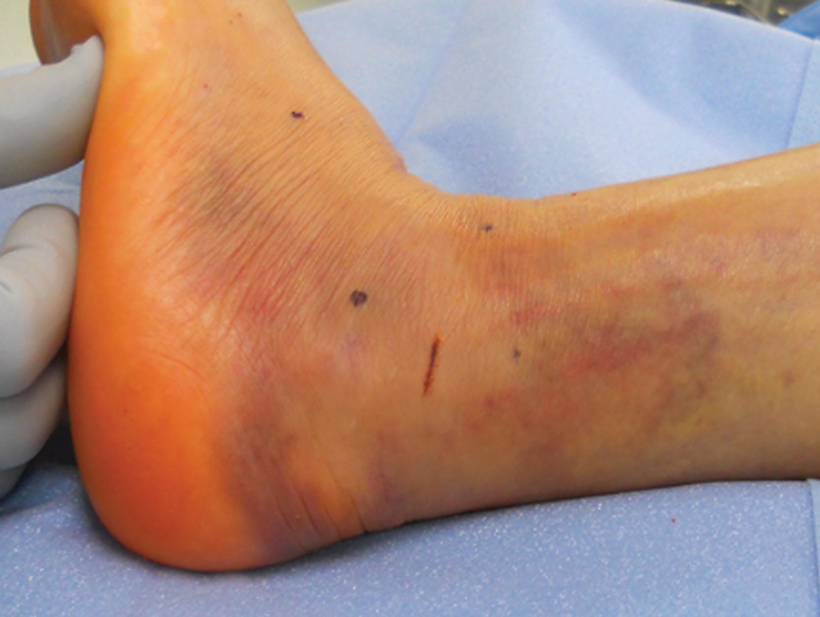 Fig. 45-20, Clinical photograph showing wrinkling of lateral skin 3 days after injury in a patient with a displaced intraarticular calcaneal fracture. The patient had been treated with an inpatient soft-tissue protocol since the day of injury. The presence of skin wrinkles indicates that soft-tissue swelling has sufficiently dissipated such that surgery may be safely performed.