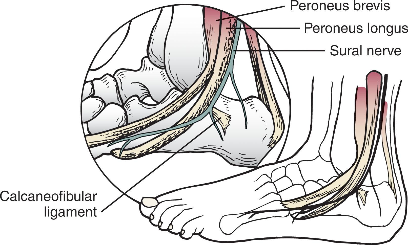 Fig. 45-2, Lateral soft tissue structures that surround the calcaneus.