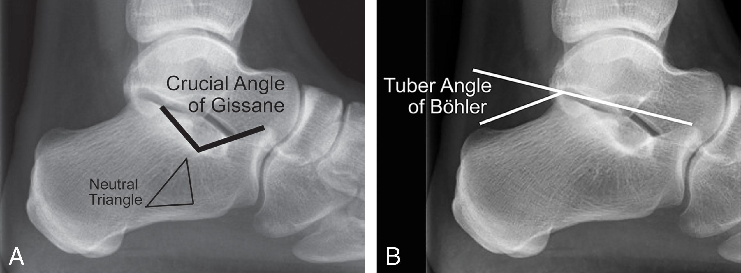 Fig. 45-4, Lateral radiograph of ankle. A , The neutral triangle and crucial angle of Gissane. B , The tuber angle of Böhler.