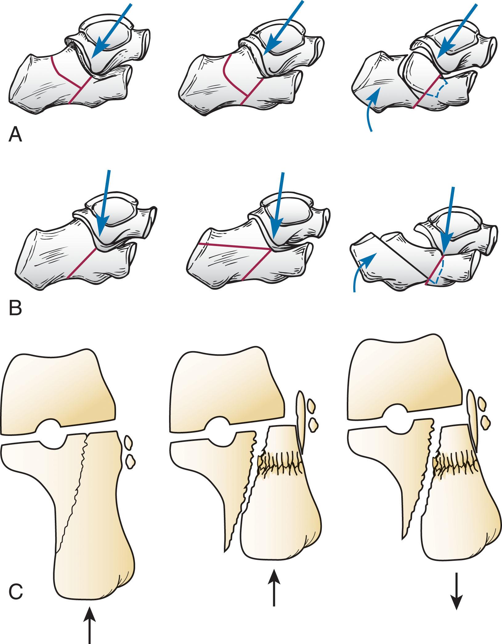 Fig. 45-5, Essex-Lopresti classification of calcaneal fractures and their mechanism of injury. A , Joint depression fracture. B , Tongue-type fracture. C , Fracture mechanism of a joint depression fracture according to Palmer.