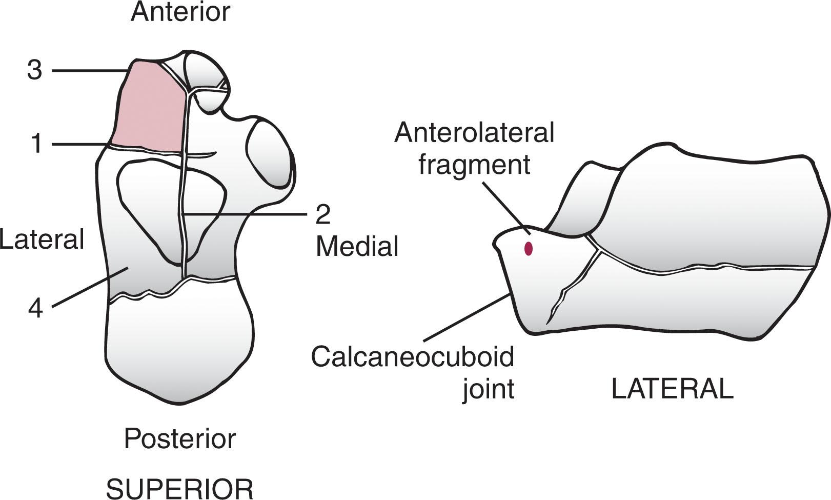 Fig. 45-6, Mechanism of injury according to Carr. 1 and 2 , Primary fracture lines; 3 , anterolateral fragment; 4 , superolateral fragment.