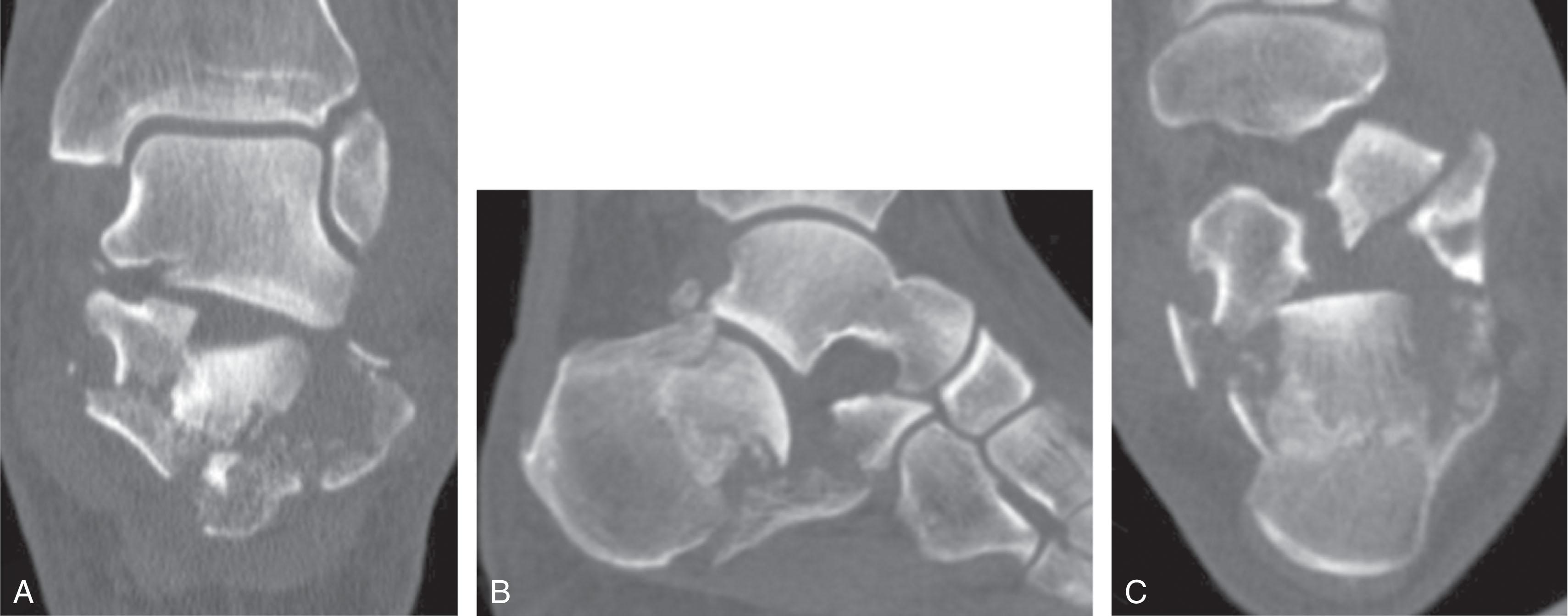 Fig. 45-7, Computed tomography scan images demonstrating the pathoanatomy of a joint-depression intraarticular calcaneal fracture. A , Coronal view. B , Sagittal view. C , Axial view.