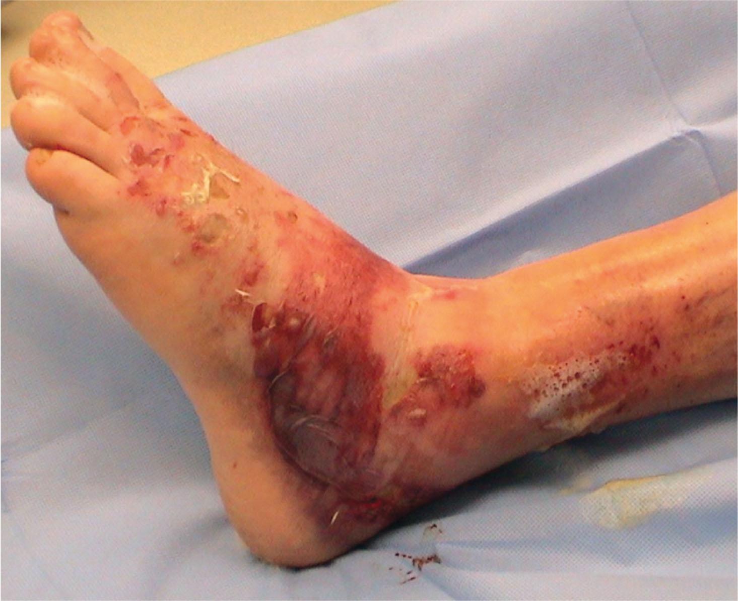 Fig. 45-8, Resolving fracture blisters. Note the large blood-filled blister overlying the lateral hindfoot.