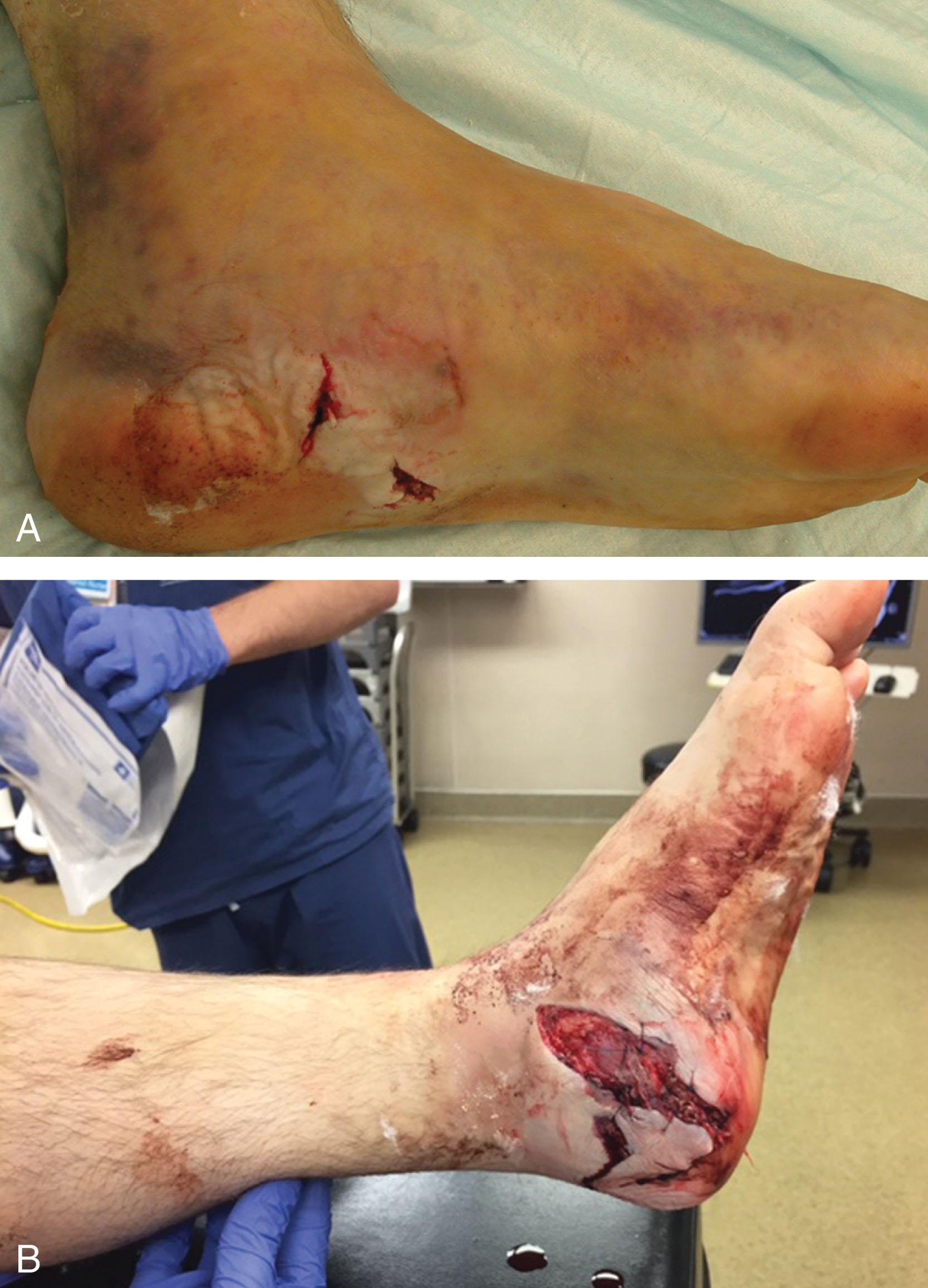 Fig. 45-9, Clinical photographs of medial wounds associated with open calcaneal fractures. A , Small puncture wound medially. B , More significant medial-posterior wound.