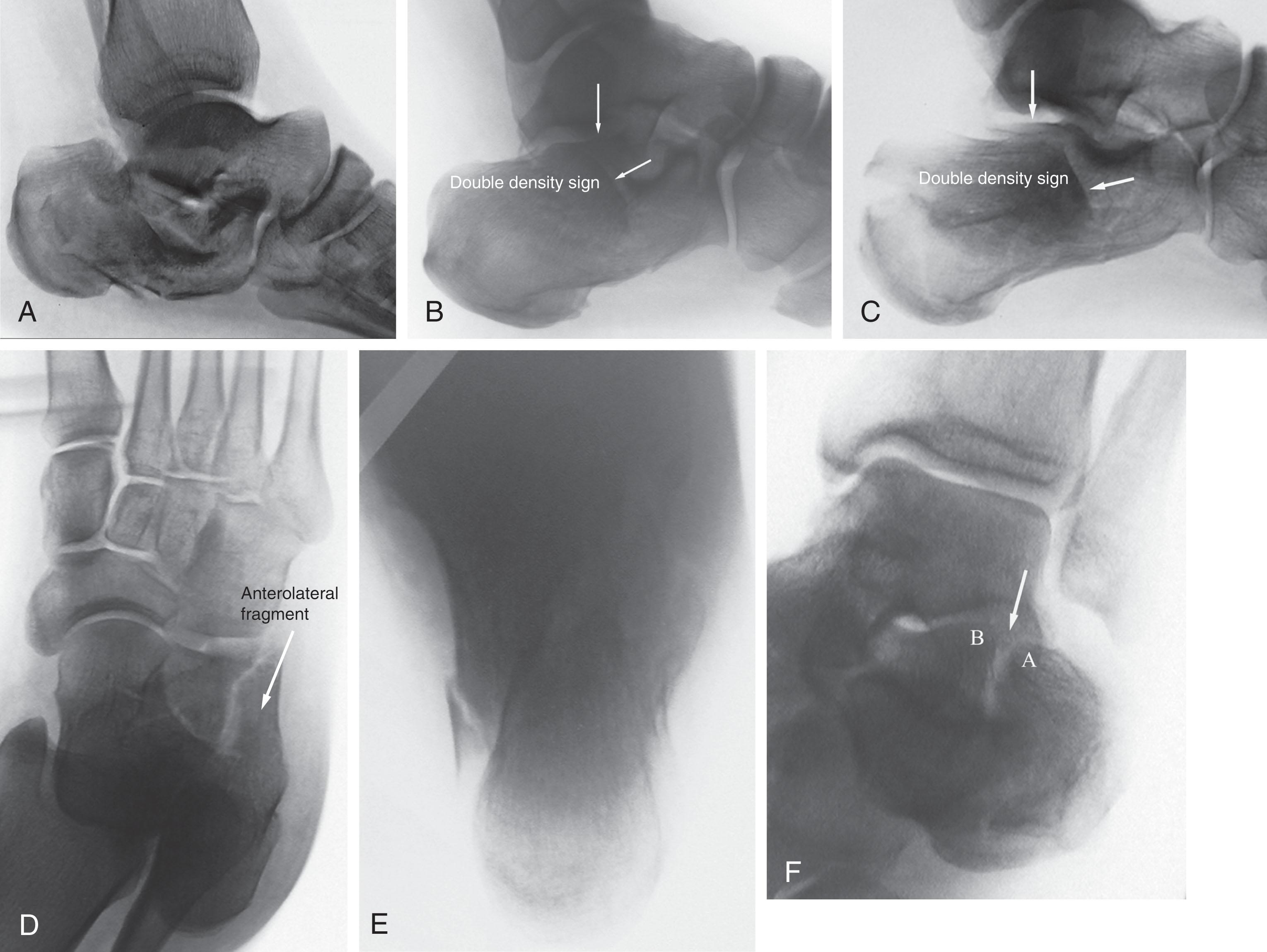 Fig. 45-10, Plain radiographs of a displaced intraarticular calcaneal fracture. A , Lateral view. Note severe loss of height, decreased Böhler angle, and increased Gissane angle. B , Lateral view of joint-depression fracture with double density sign (arrows) . C , Tongue-type fracture with double density sign (arrows) . D , Anteroposterior view of foot. E , Harris axial view. Note shortening and varus angulation of tuberosity. F , Mortise view of ankle. Arrow indicates fracture. A , superolateral fragment; B , sustentacular constant fragment.