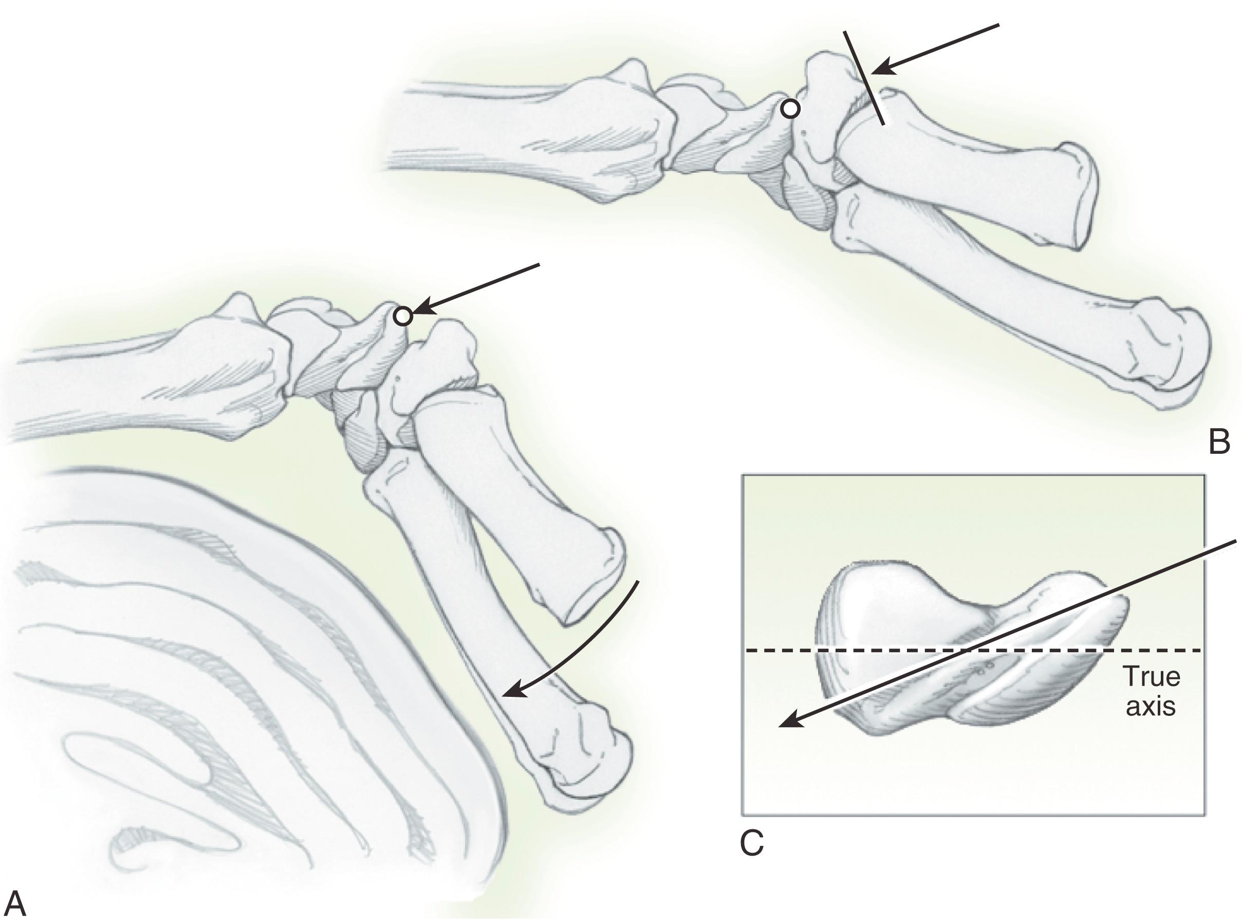 Fig. 16.11, A, With the wrist in neutral position, the trapezium blocks the scaphoid bone. B, With the wrist in the hyperextended position, the trapezium moves dorsally out of the way for access to the starting point on the scaphoid bone. C, Even with the wrist extended, it is not possible to get down the true axis from the volar approach because the trapezium is in the way.