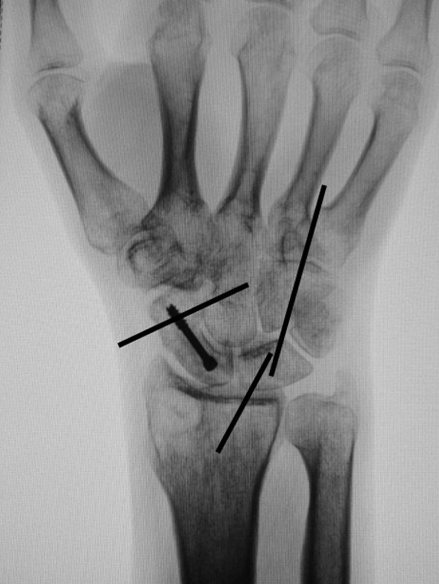 Fig. 16.16, Example of supplemental fixation for stability.