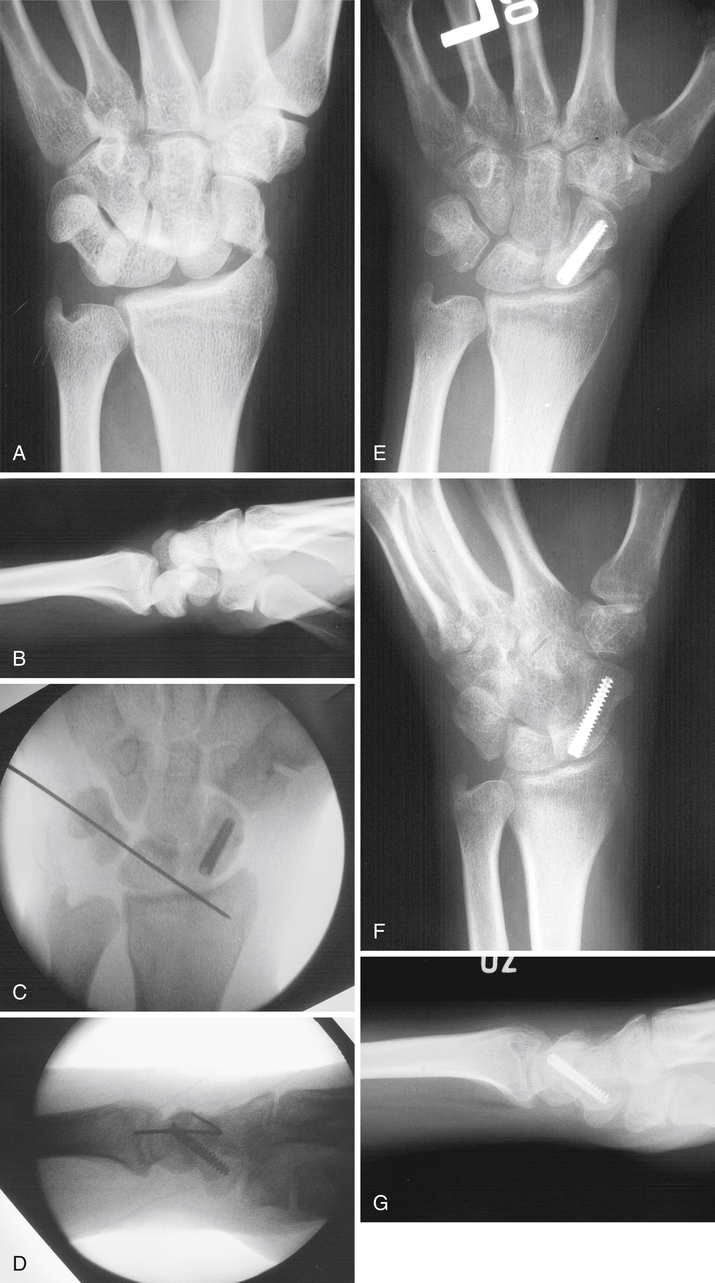 Fig. 16.17, Perilunate fracture dislocation with preoperative (A) AP and (B) lateral radiographs. C and D demonstrate introperative AP and lateral views of the fixation. E to G demonstrate radiographs taken 1 year postoperatively. H, Range of motion at 1 year postoperatively following fixation of perilunate fracture dislocation.