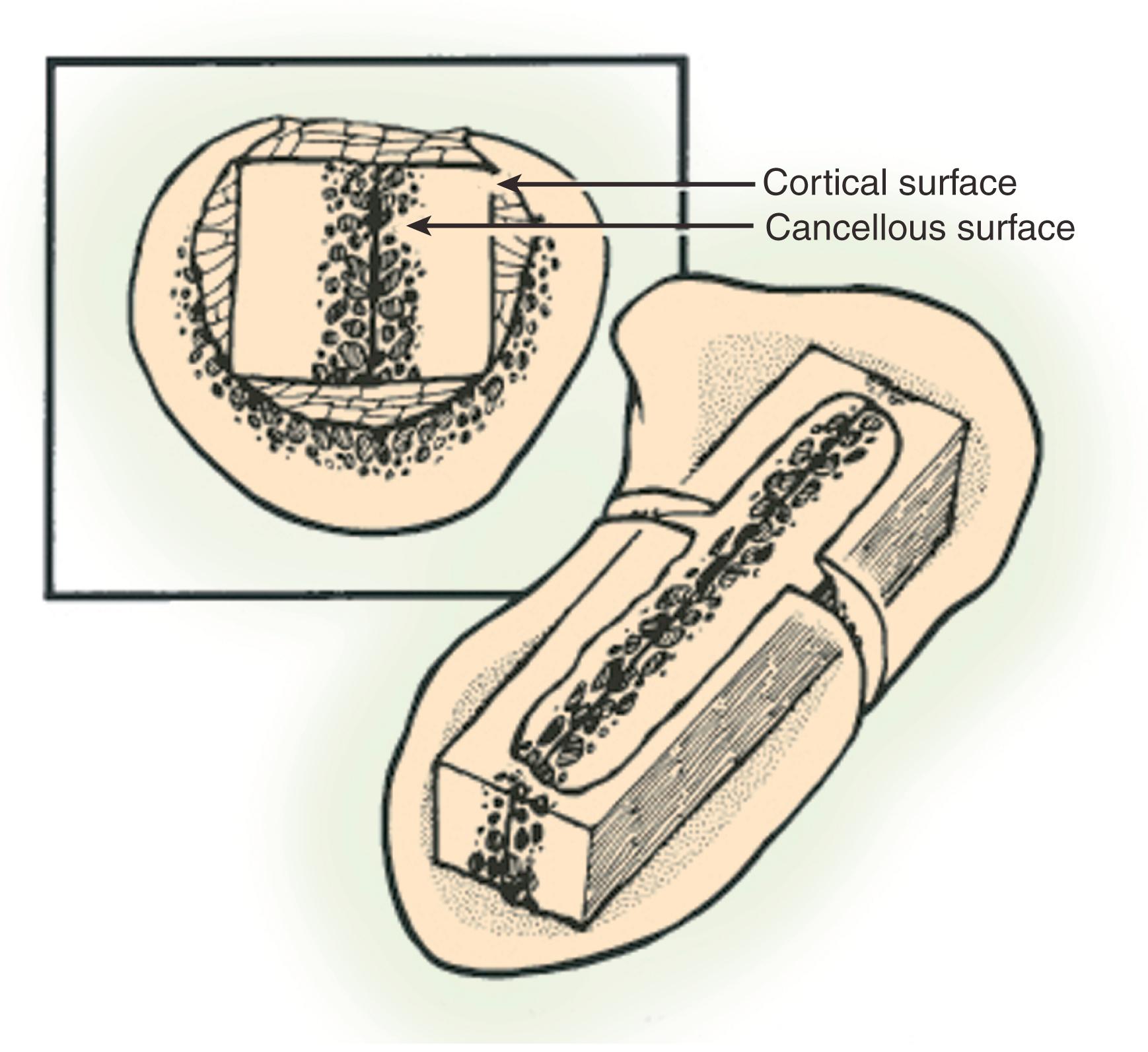 Fig. 16.18, Russe technique using two corticocancellous bone grafts.